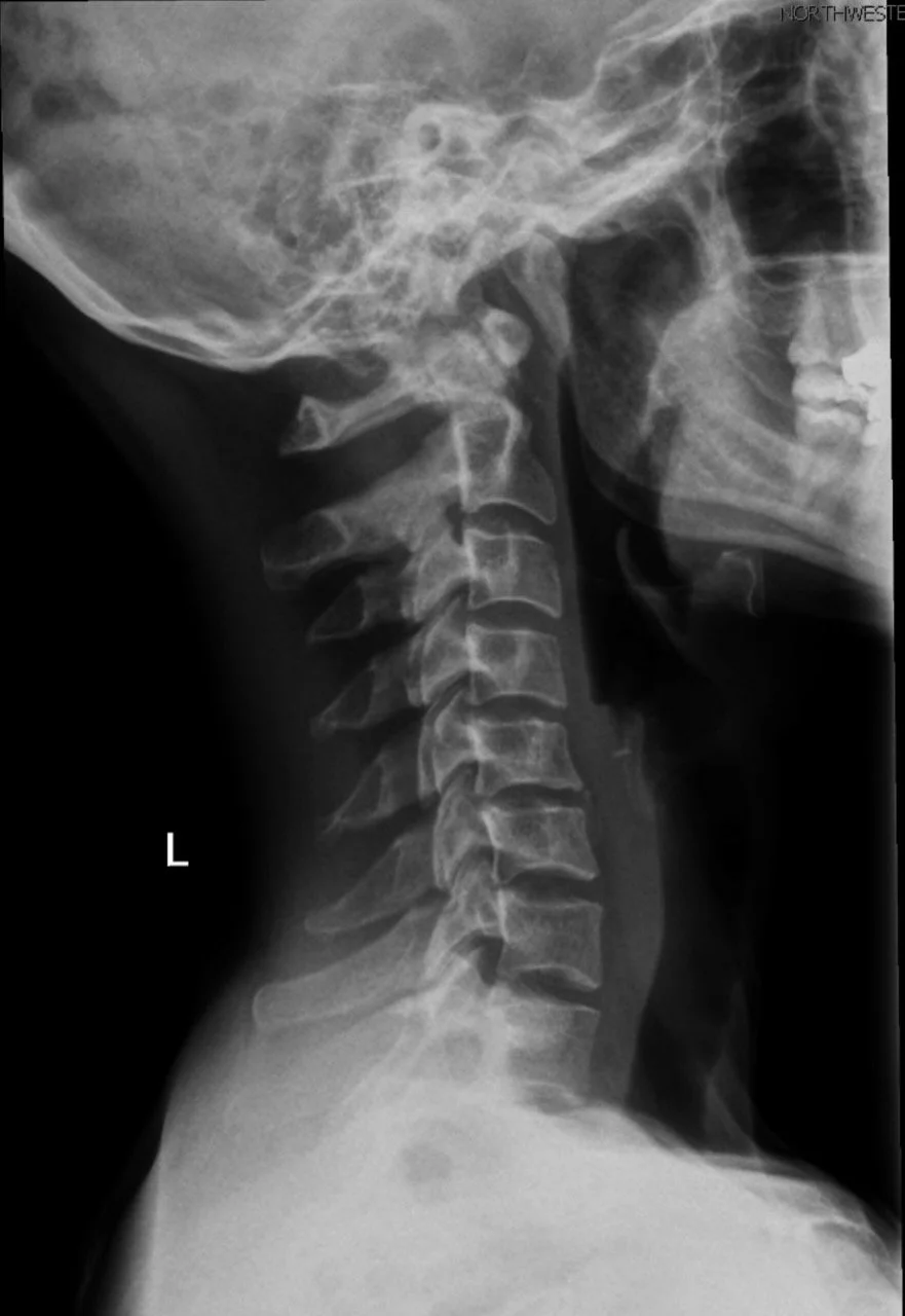 X-ray cervical.jpeg