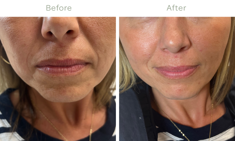   Nasolabial Folds Filler Results after injections*  