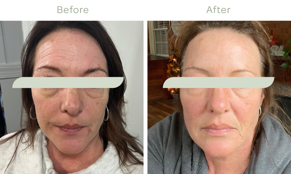   RF Microneedling with PRP Results after procedure*  