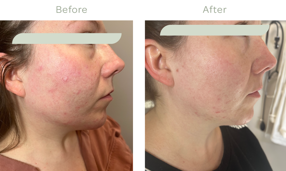   BBL® Forever Clear™ Acne Treatment Results 2 weeks after treatment*  