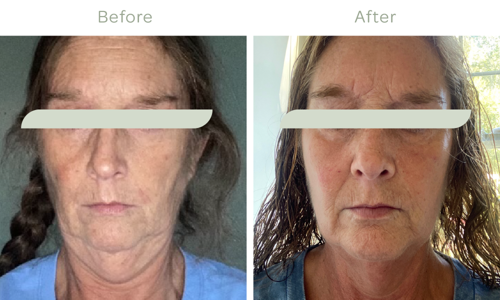   RF Microneedling with PRP Results after 3 treatments*  