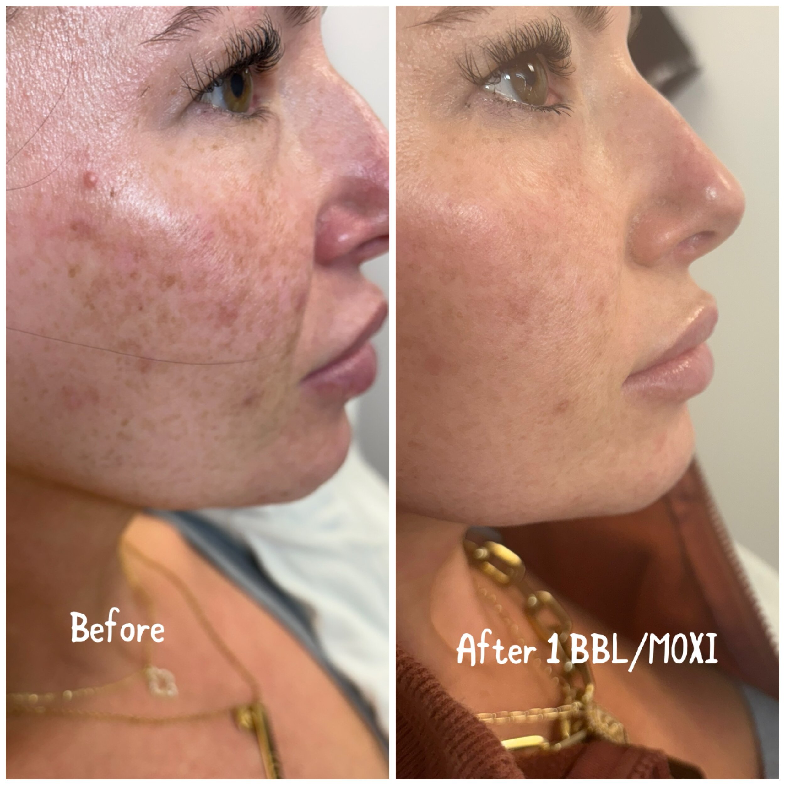 We are sooo happy with these results after only one BBL/Moxi treatment!!! Book your appointment now and get your treatment done soon. Wellness Revolution will be closed from 3/29 until 4/8