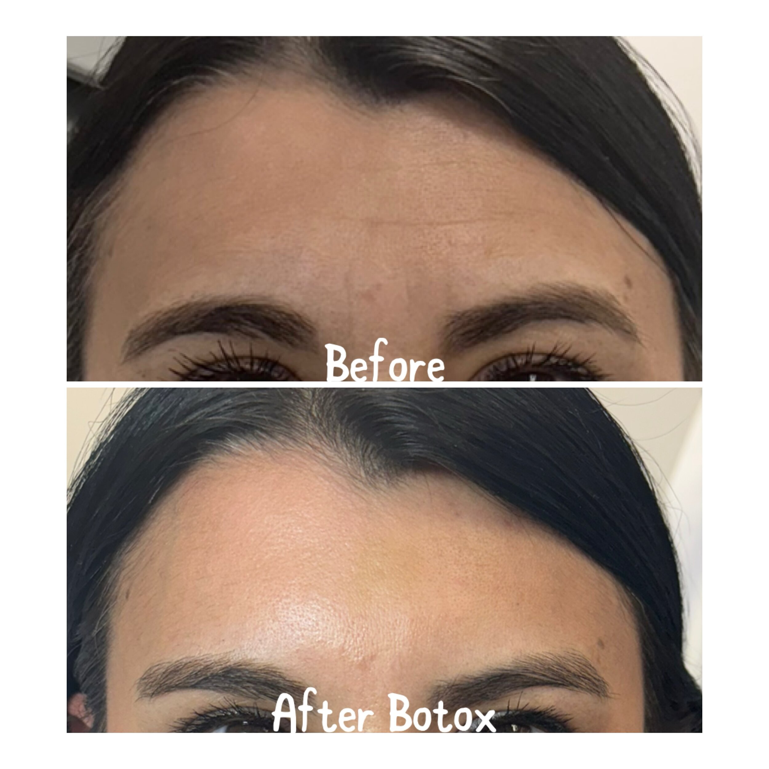 Smooth out the wrinkles and embrace a flawless glow with Botox ✨ Say hello to a refreshed, rejuvenated you! 💉 #BotoxBeauty #YouthfulGlow