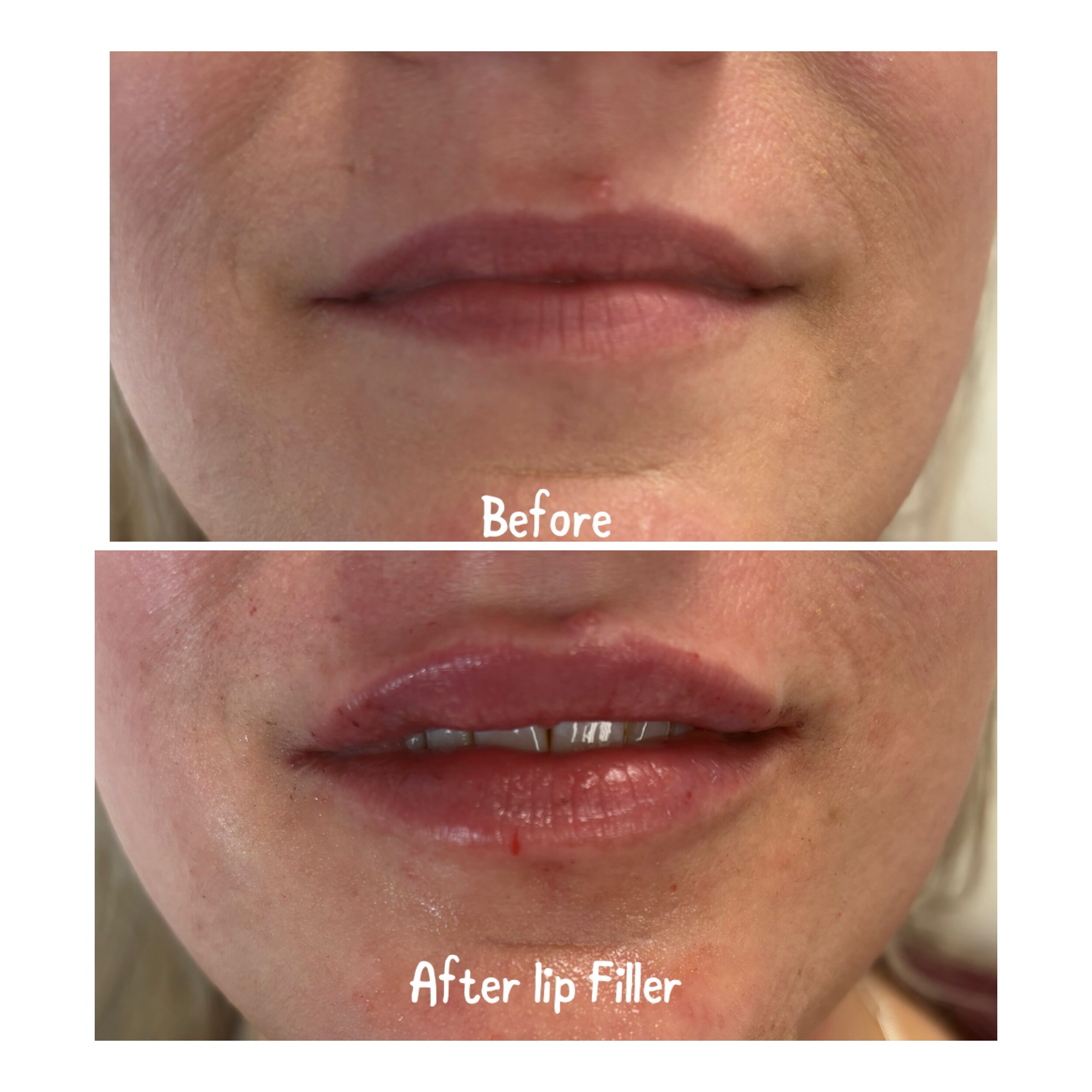 Pucker up and book your appointment for Filler Friday on April 19th to save $75 off of filler 💋
