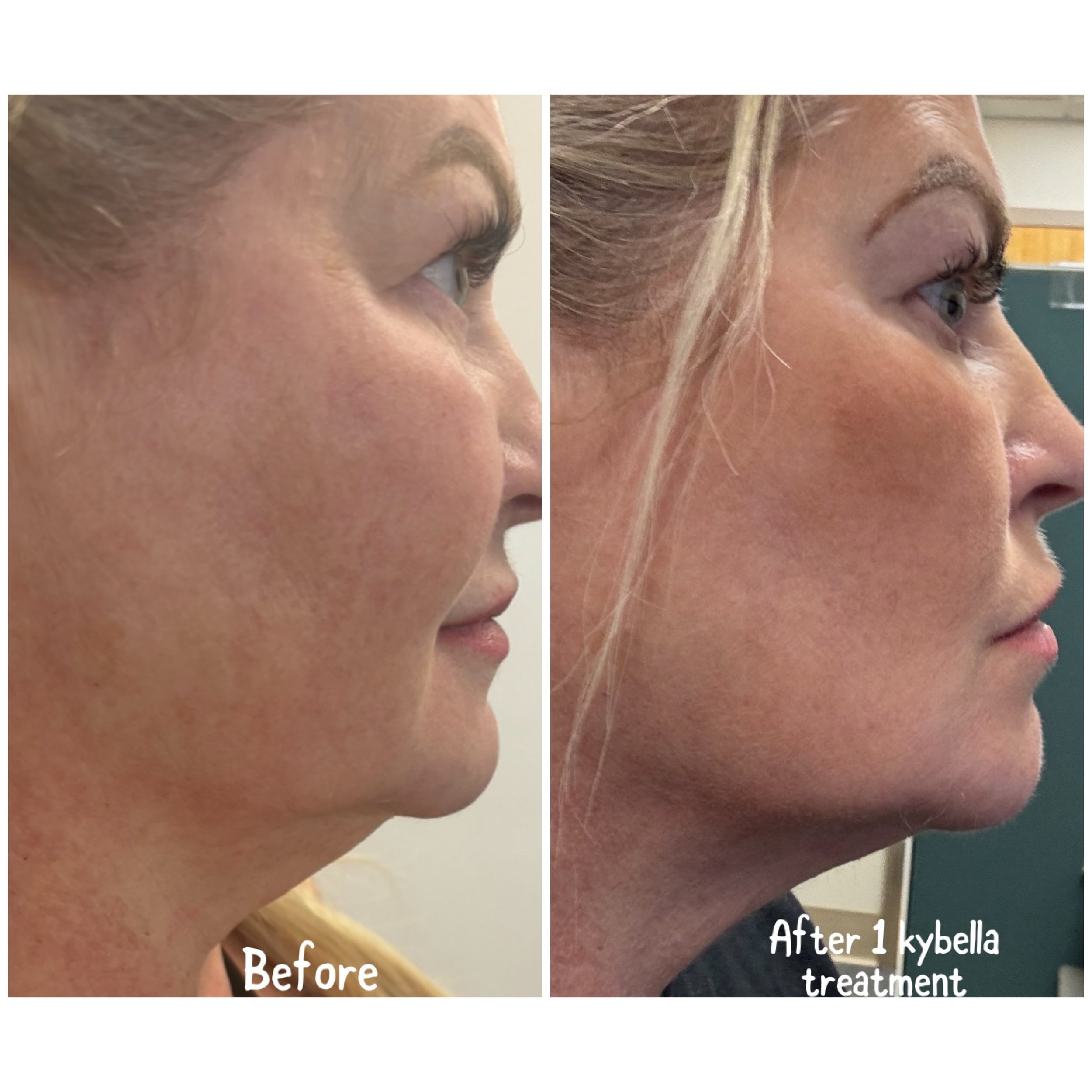 Before and after one Kybella treatment! Kybella destroys fat cells in the injected area and is often used to eliminate a &ldquo;double chin.&rdquo; Book your appointment now and permanently melt those fat cells away!