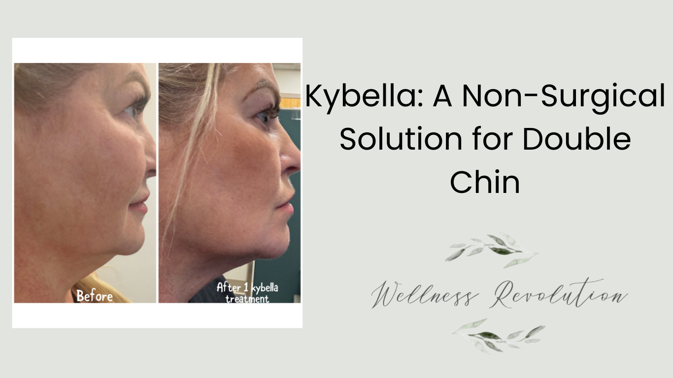 Kybella: A Non-Surgical Solution for Double Chin