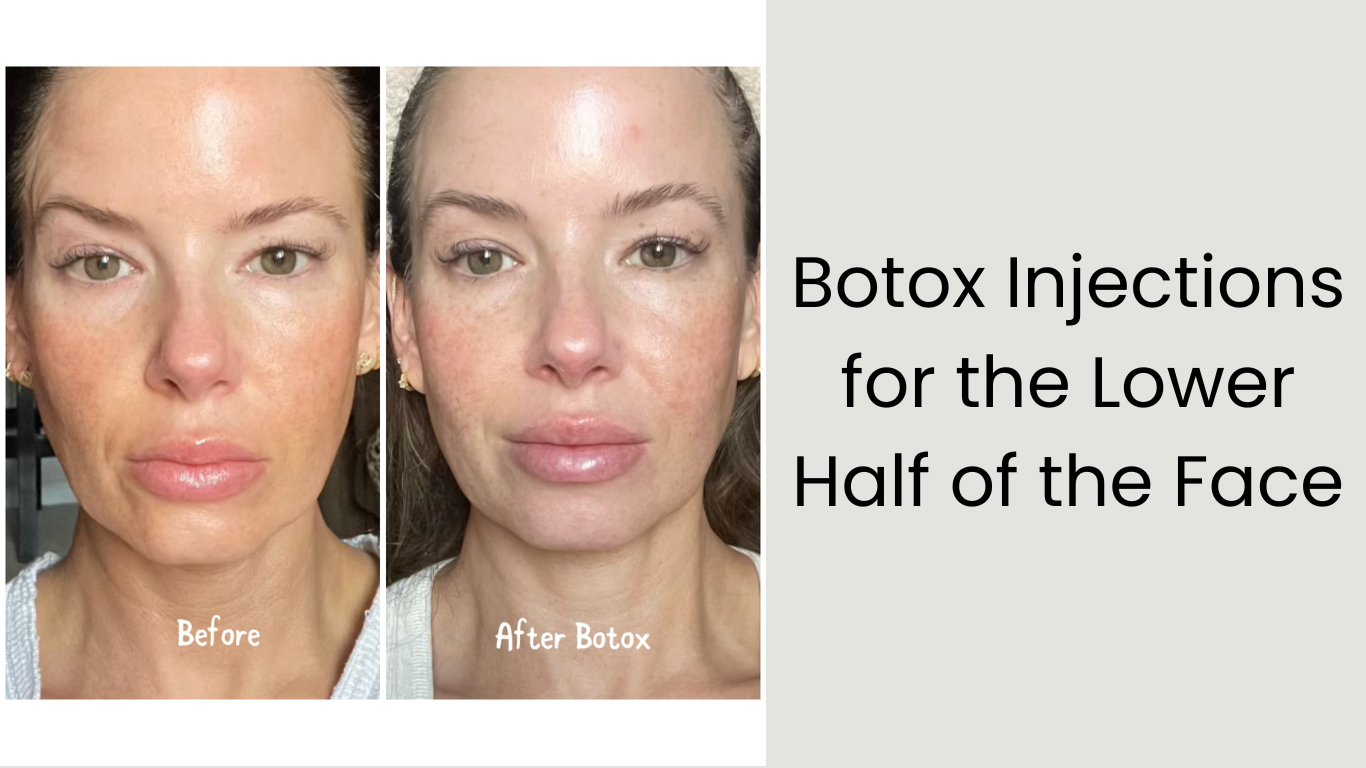 Enhancing Your Beauty: Botox Injections for the Lower Half of the Face