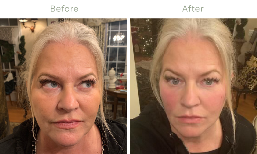   VOLUMA® Filler Results immediately after injections*  