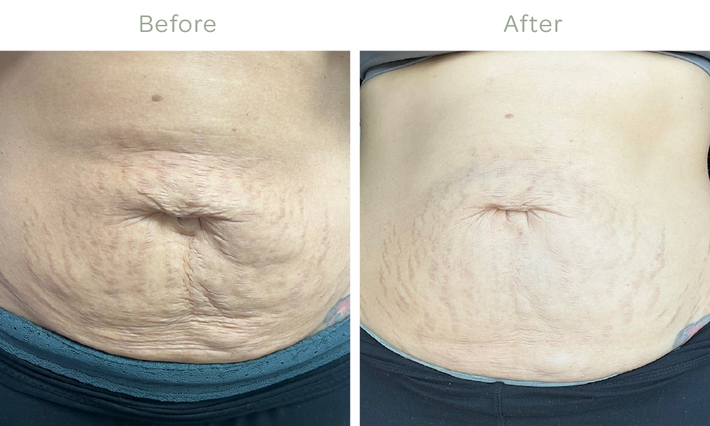   Body Shaping and RF Microneedling with PRP Treatments Day 2 Results*  