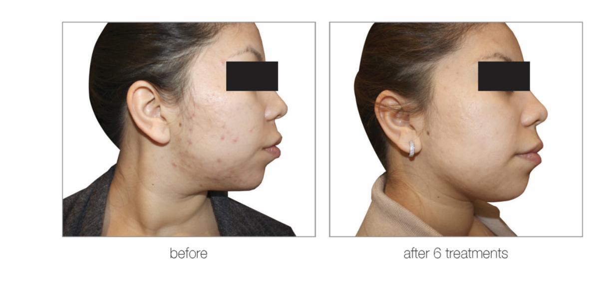 Laser Treatments Calgary, AB, Canada Laser Treatment and Aesthetic Clinic — BluOrchid Aesthetics