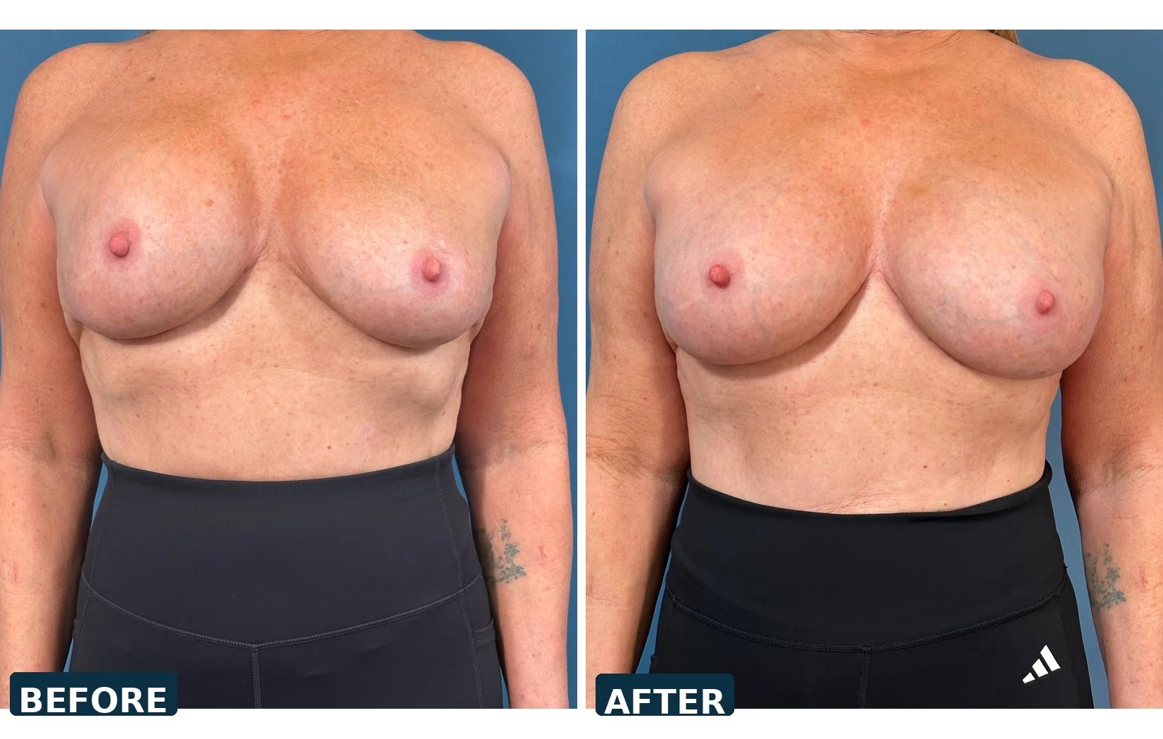 Bilateral Capsulectomy and Implant Exchange  treating capsular contracture 