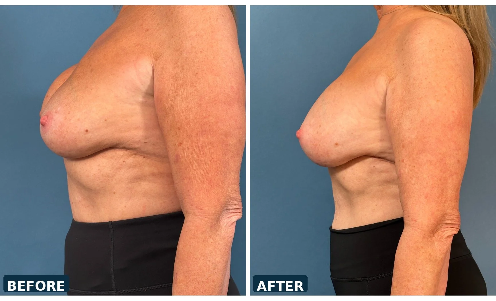 Bilateral Capsulectomy and Implant Exchange  treating capsular contracture 