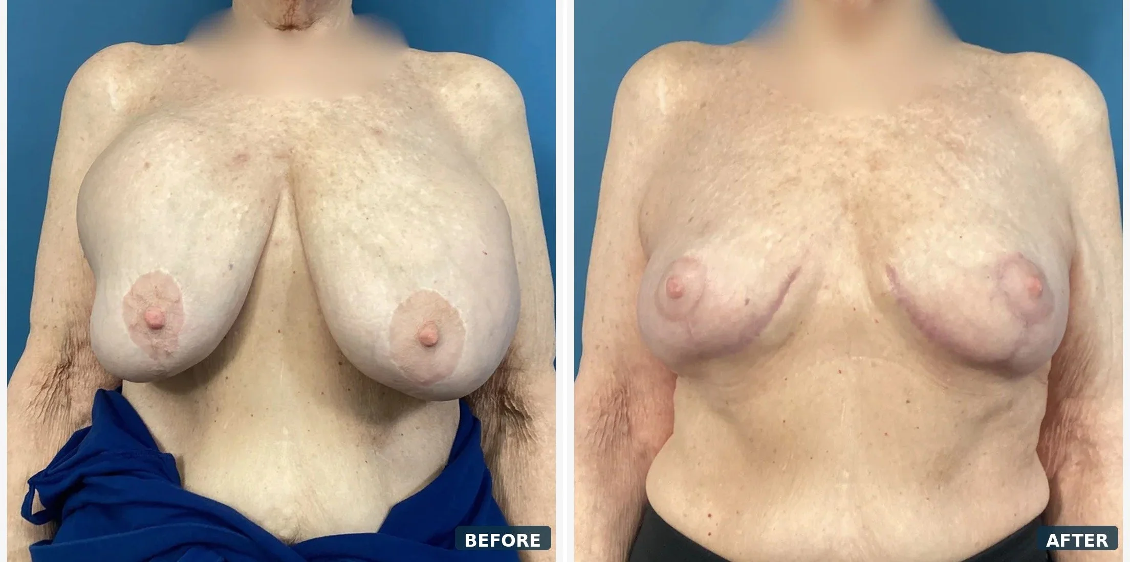 Bilateral Capsuiectomy & Implant Removal & Mastopexy, correction of capsular contracture 