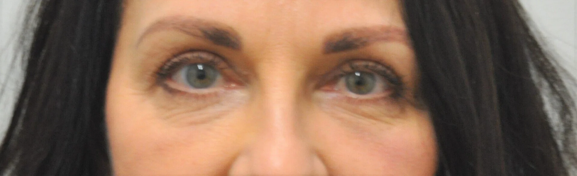 After Upper Blepharoplasty