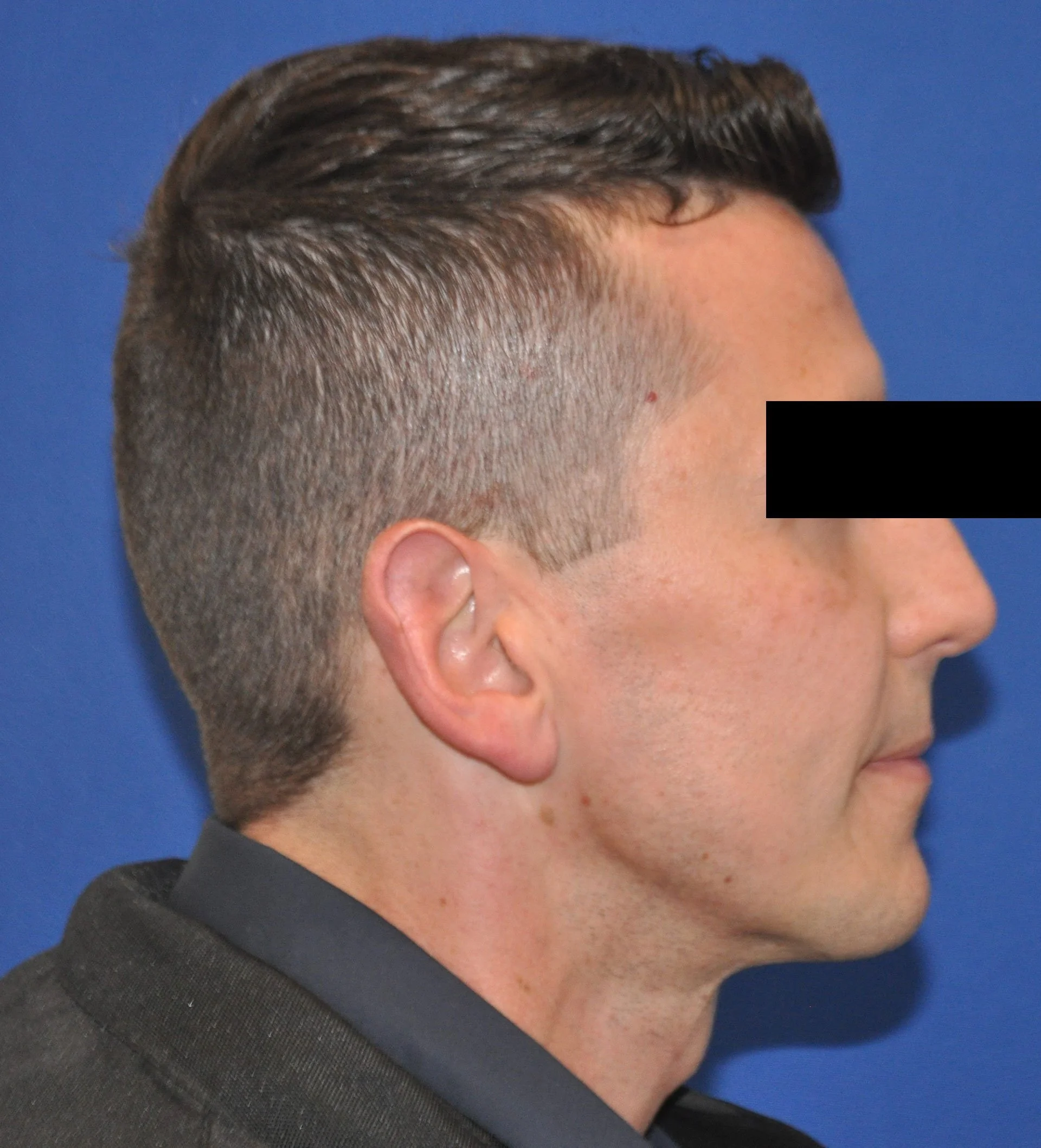 Facial Fat Grafting Surgery — Pearl Plastic Surgery and Medical Spa