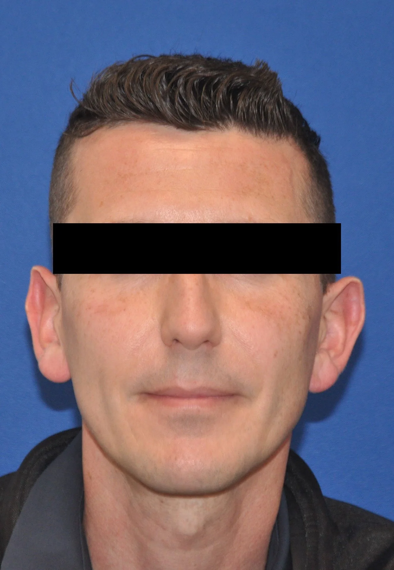 After Facial Fat Grafting