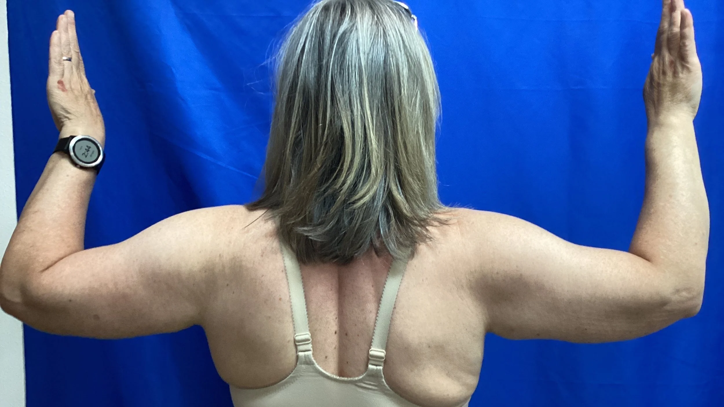 After Liposuction and Renuvion of Arms