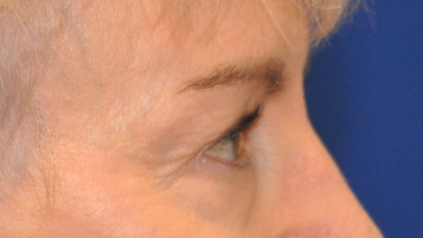 After Upper Blepharoplasty