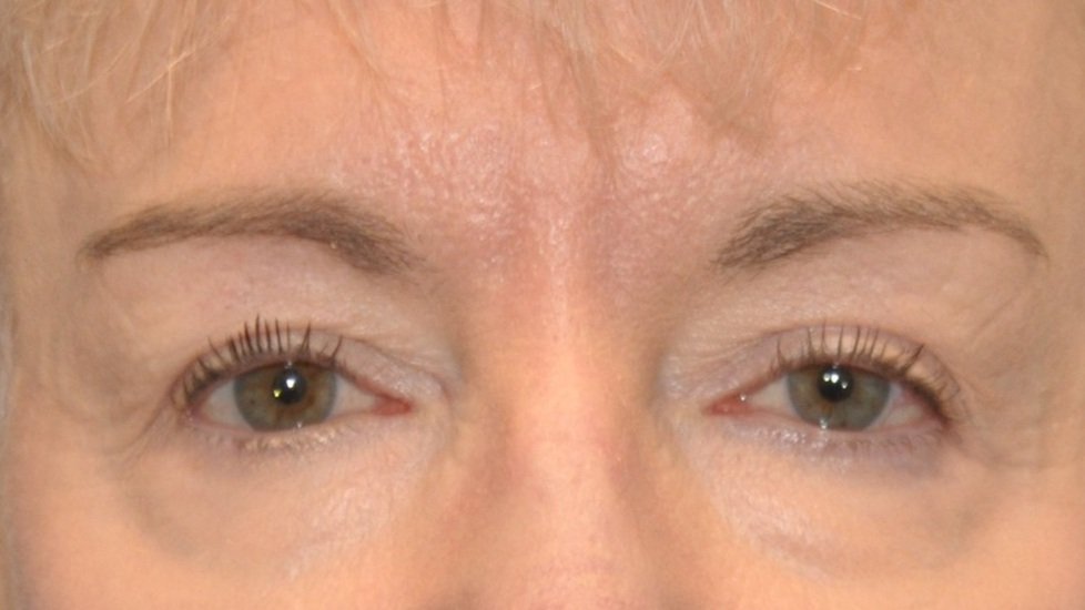 After Upper Blepharoplasty