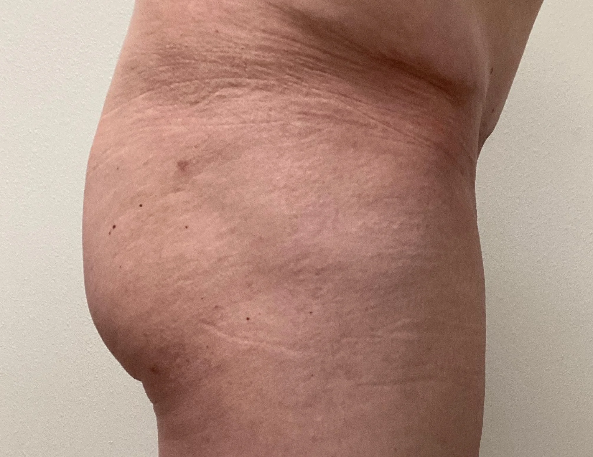 BBL 6mo post op.jpeg