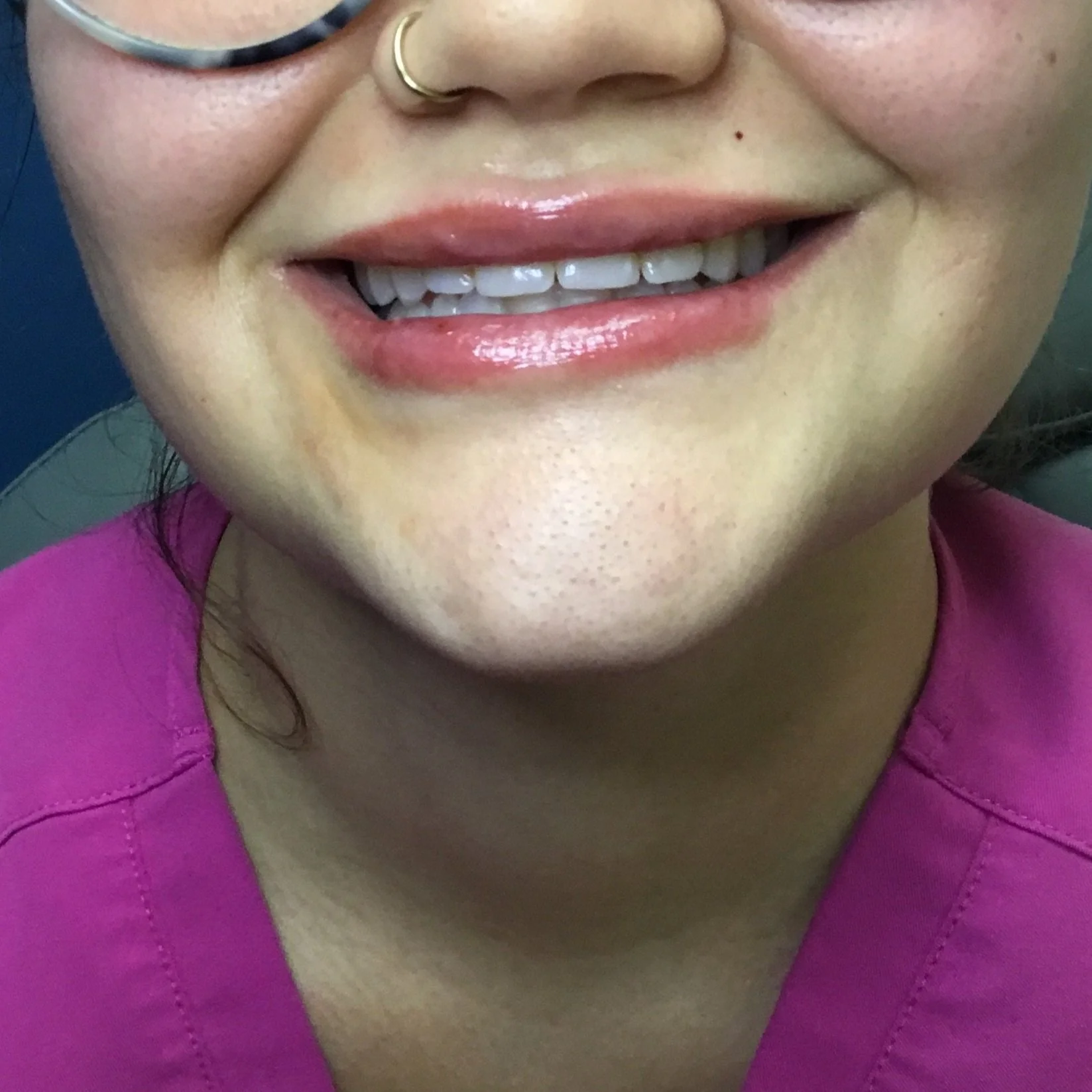After 0.6cc RHA 2 Lip Filler
