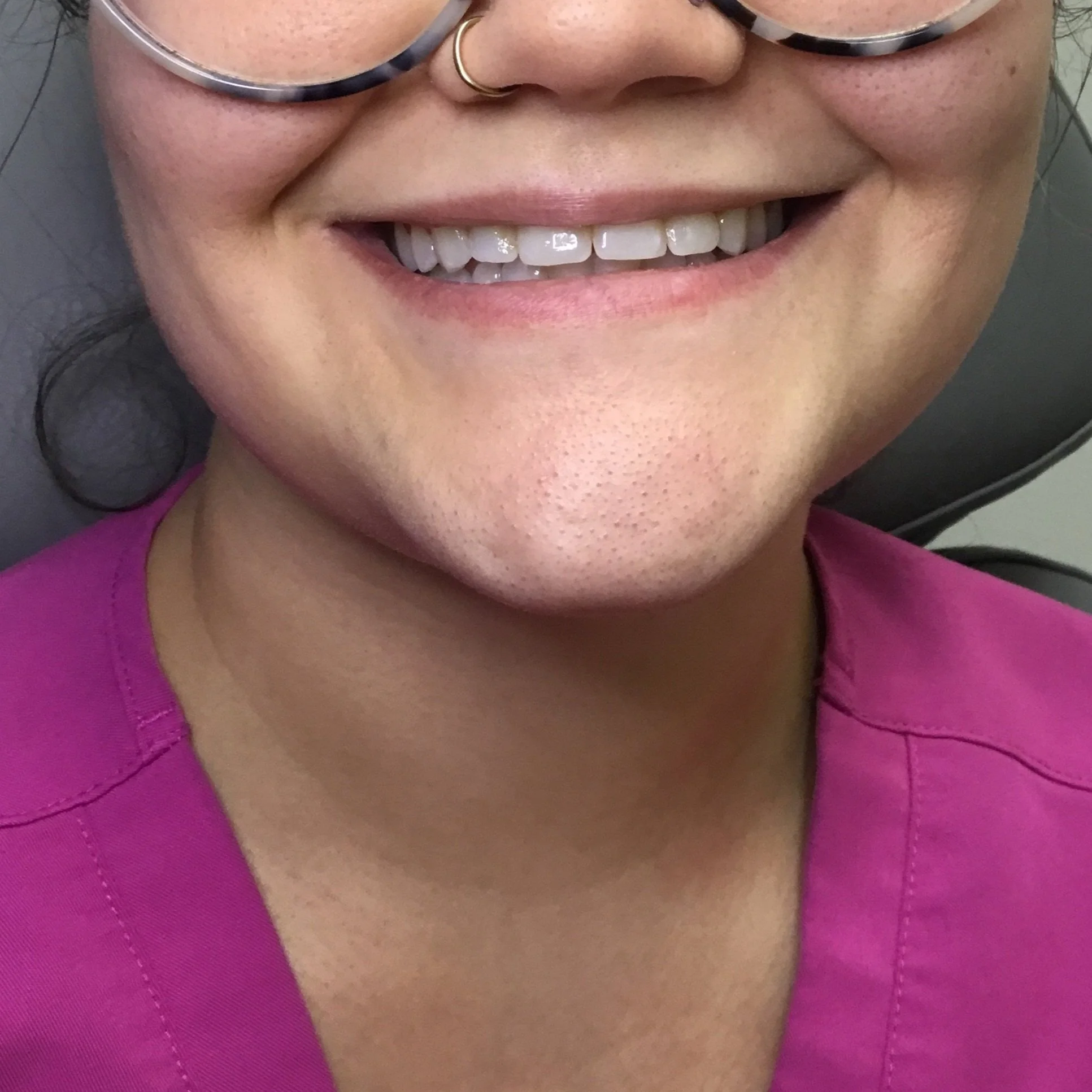Before Lip Filler