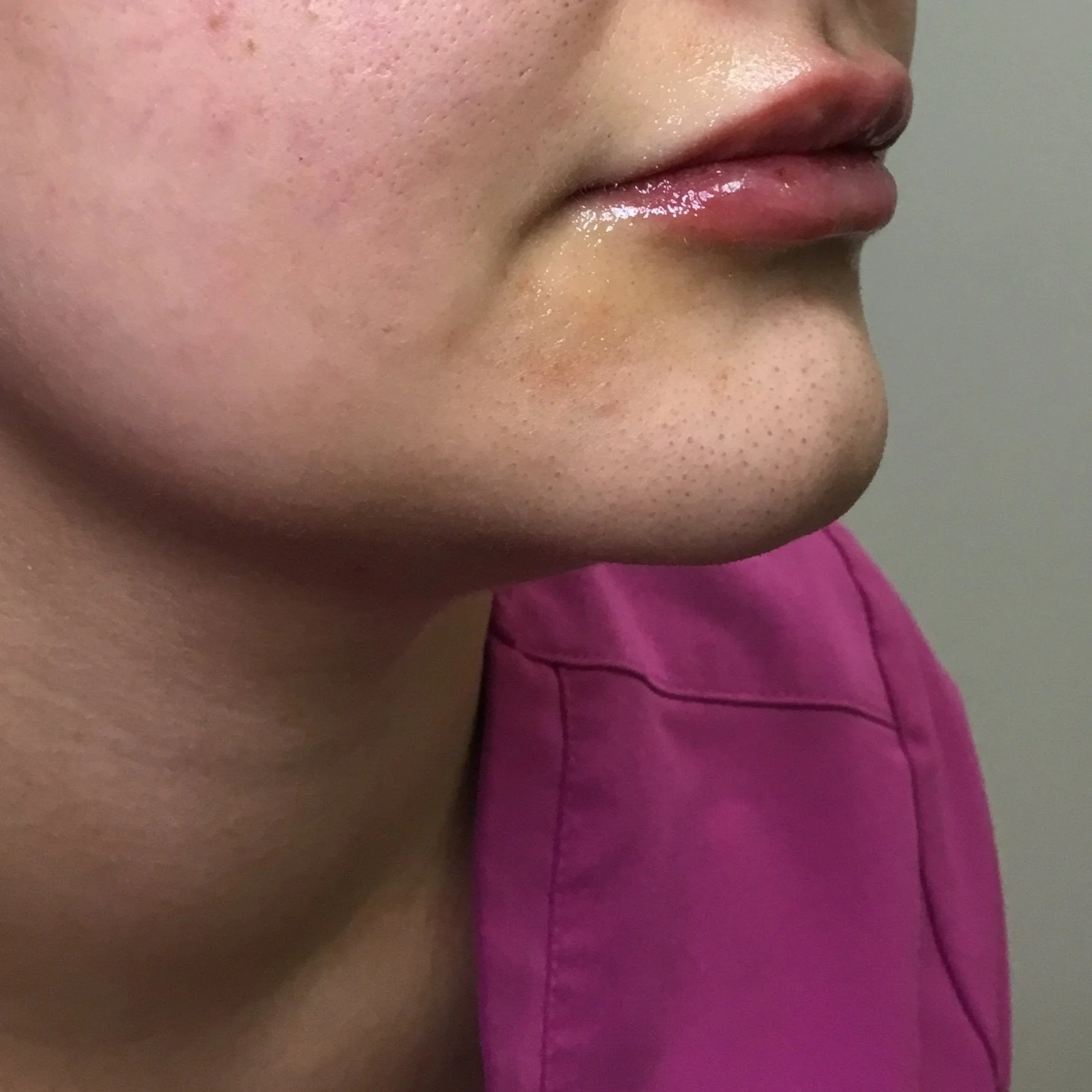 After 0.6cc RHA 2 Lip Filler