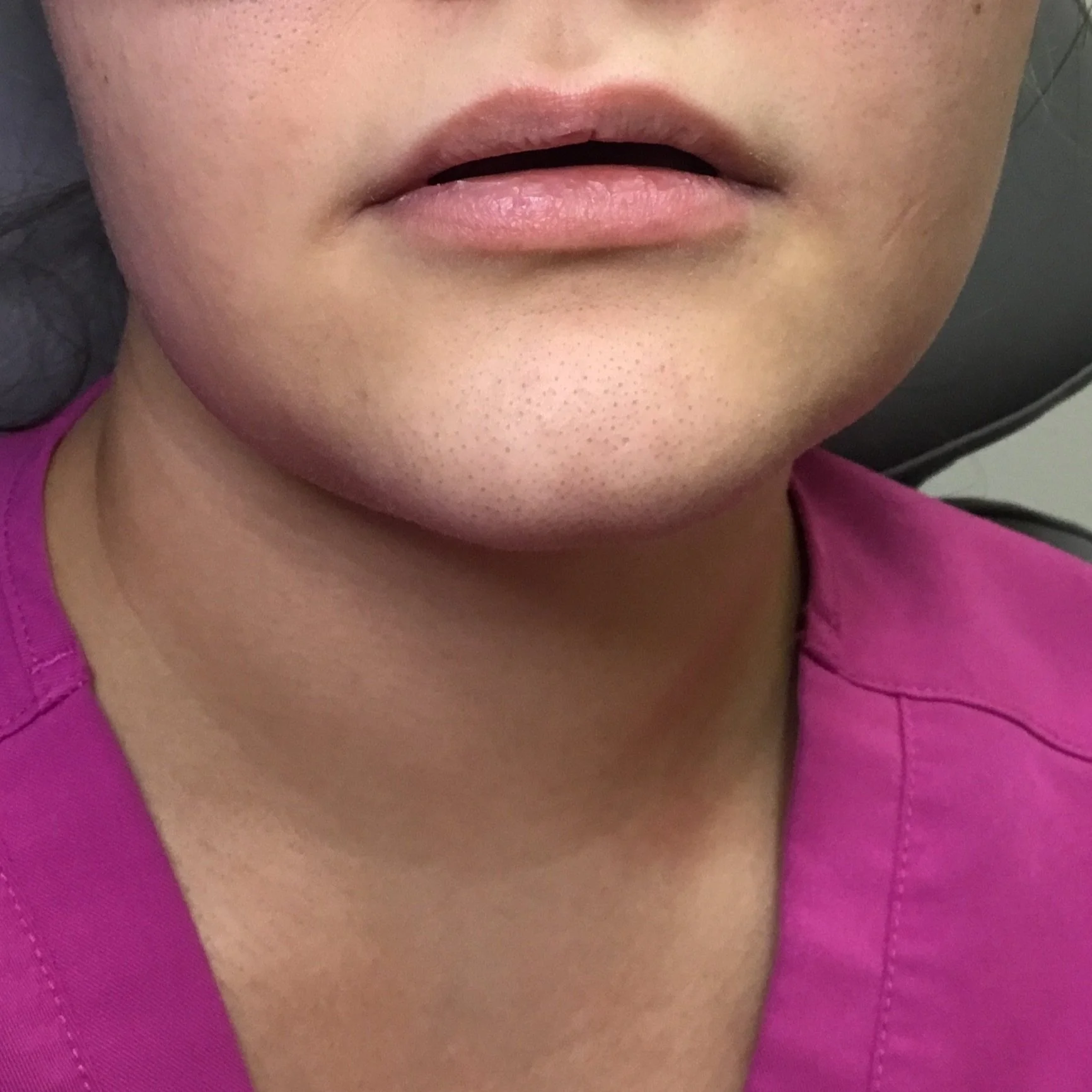 Before Lip Filler