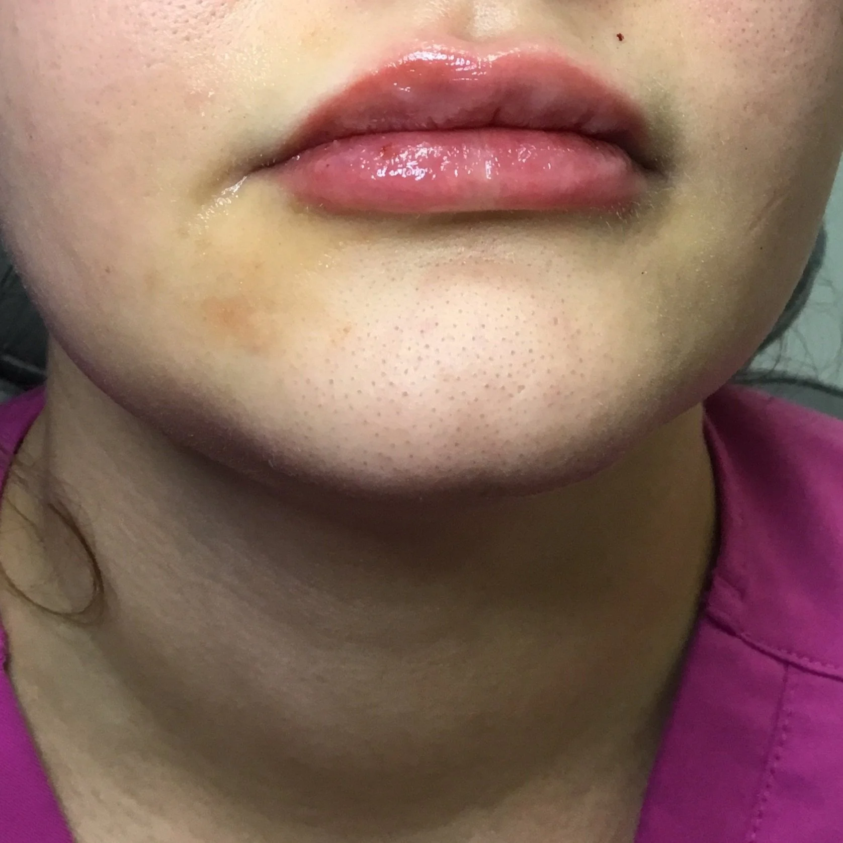 After 0.6cc RHA 2 Lip Filler