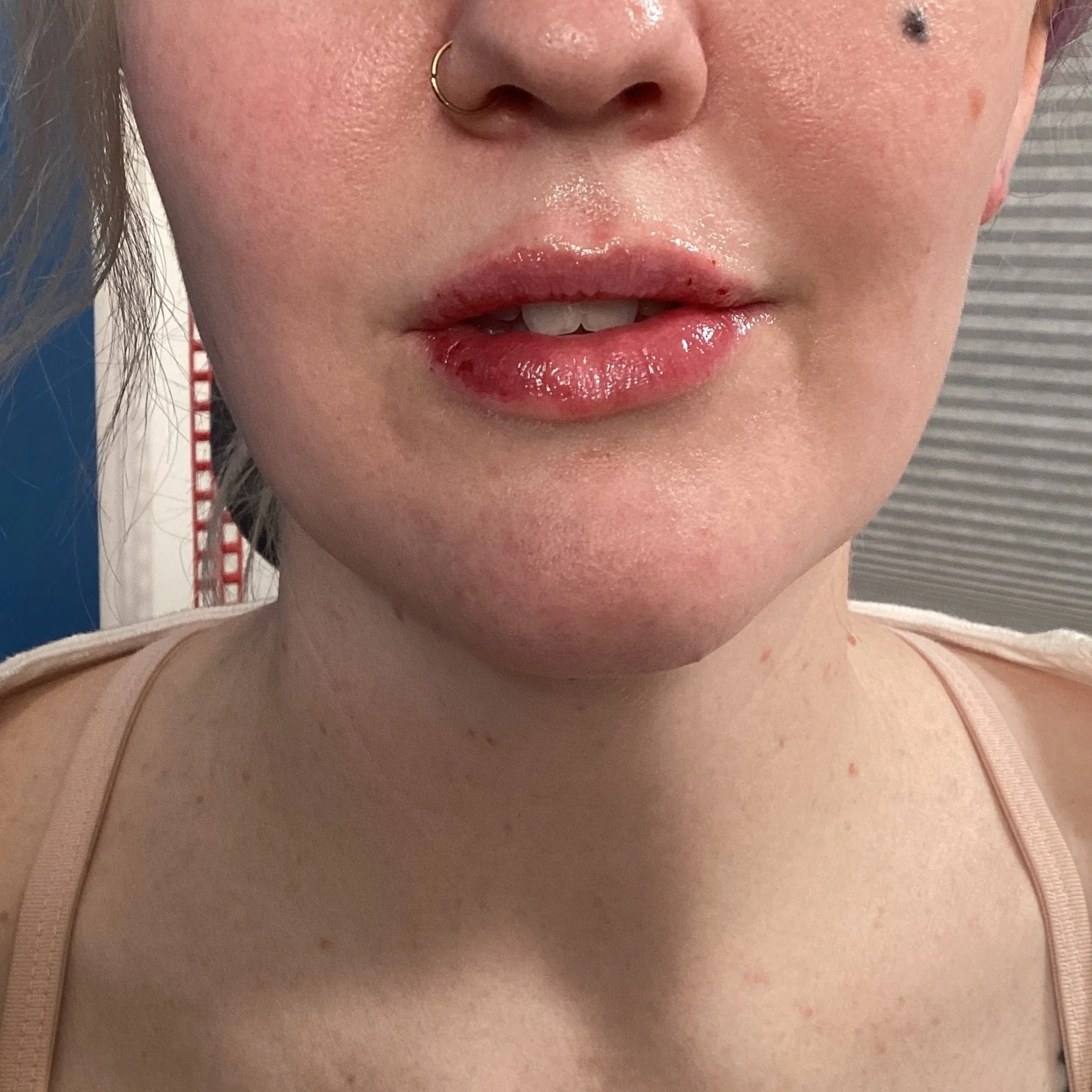 After 0.5cc RHA 2 Lip Filler