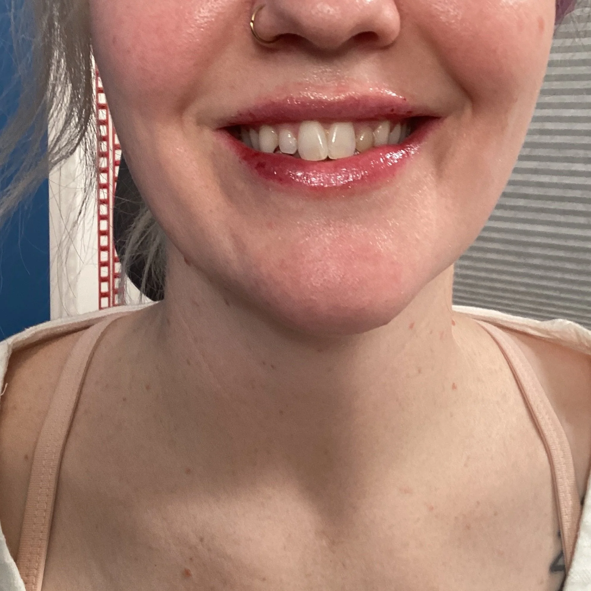 After 0.5cc RHA 2 Lip Filler