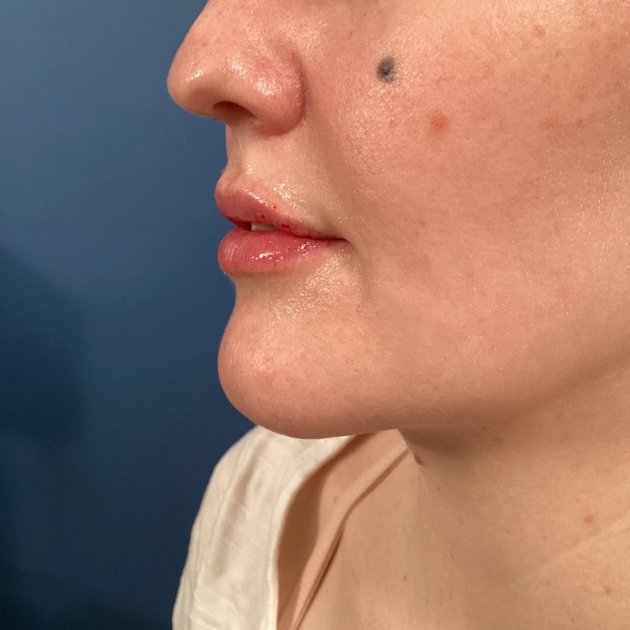 After 0.5cc RHA 2 Lip Filler