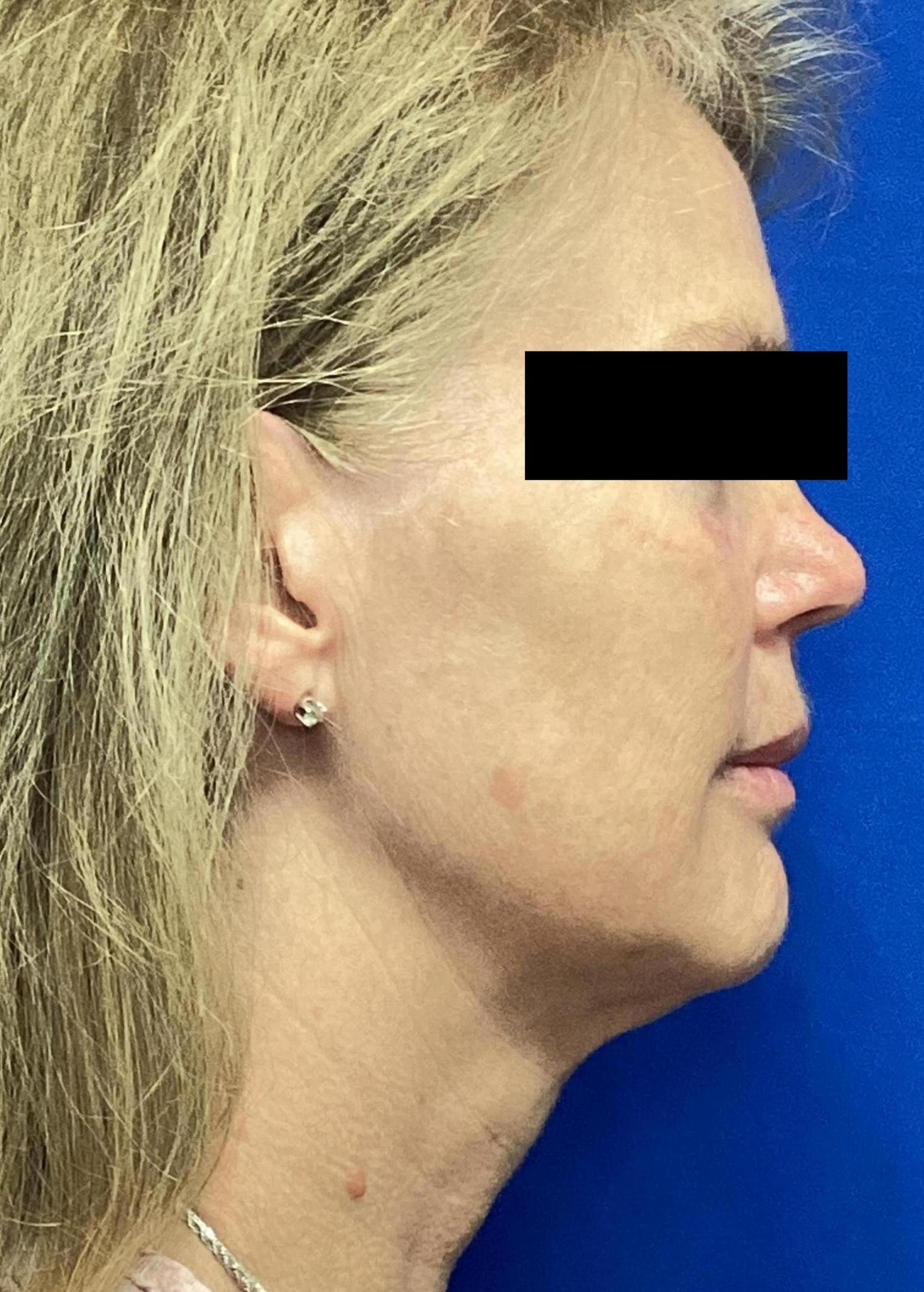 After Facial Fat Grafting and Neck Liposuction with Renuvion