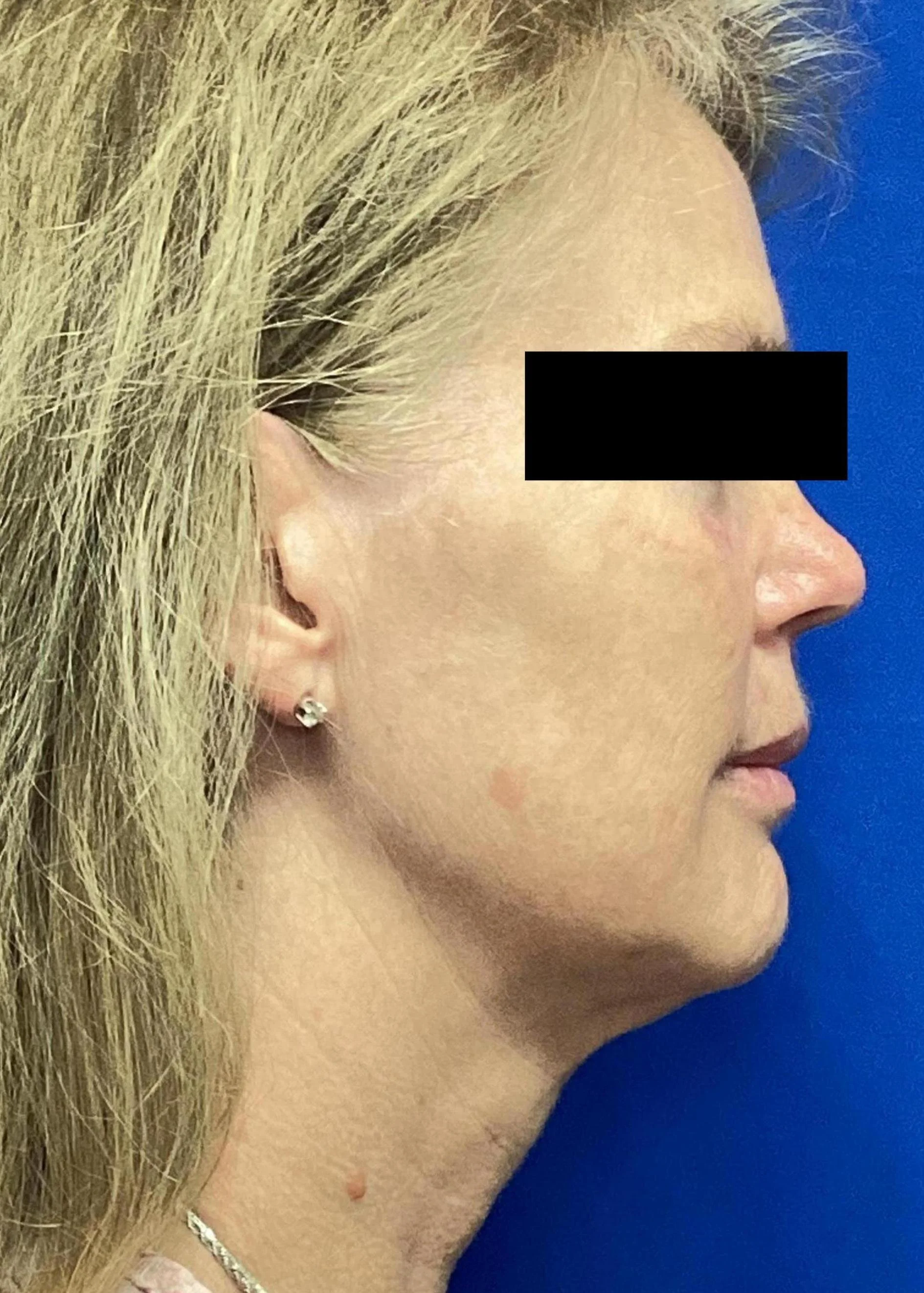 After Facial Fat Grafting and Neck Liposuction with Renuvion