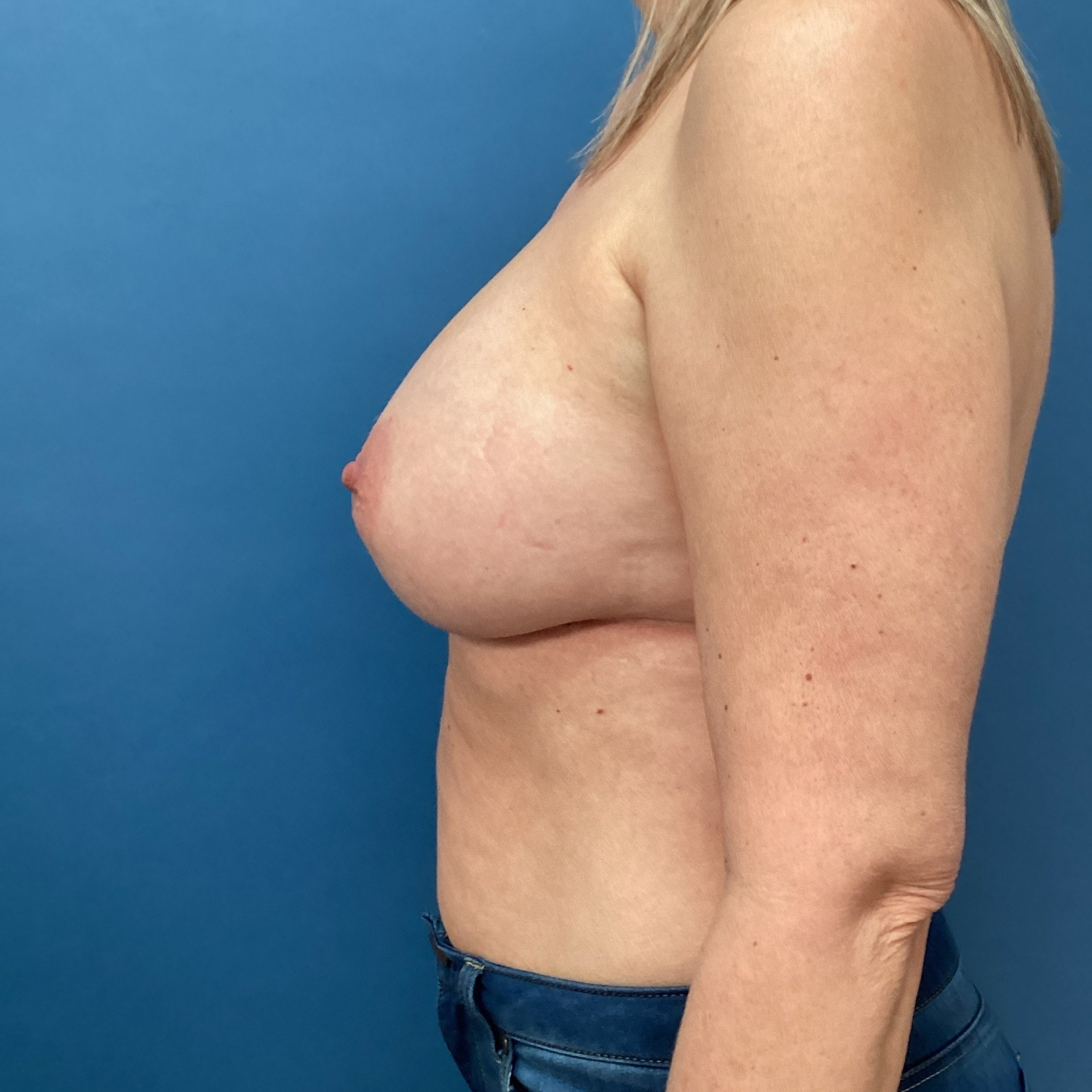 After Breast Augmentation with 365cc High Profile Sientra implants