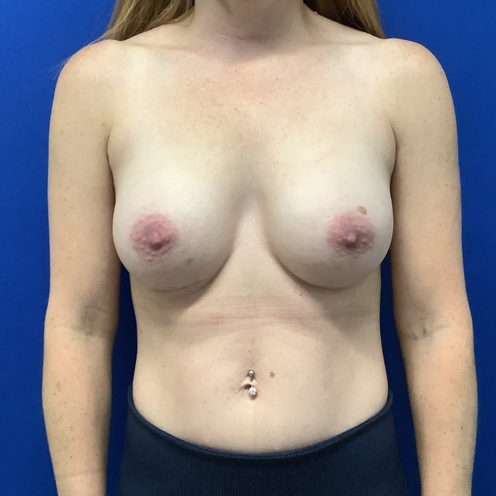 breast-anterior-10.19.2021-26257179.jpg