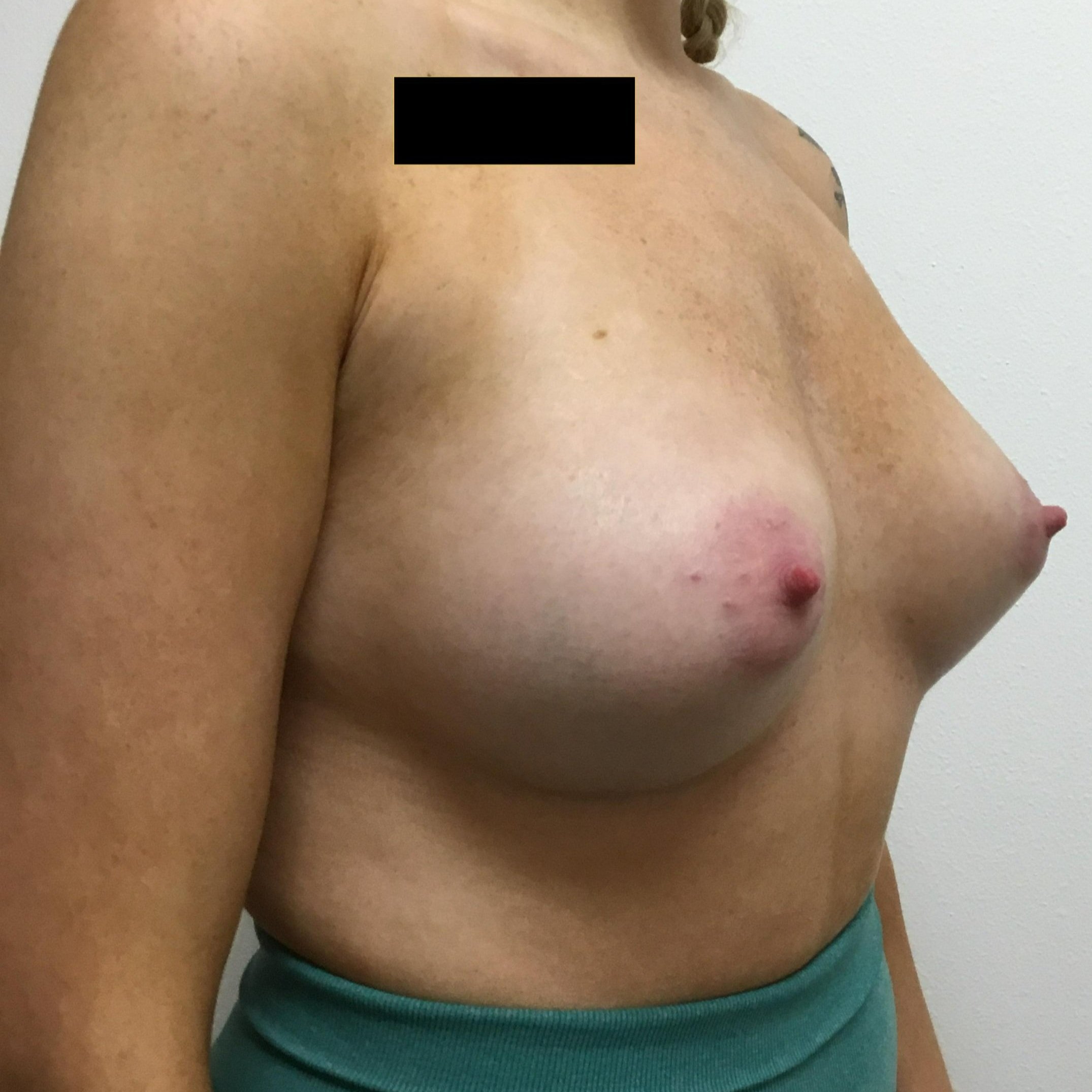 breast-anterior-oblique-right-05.24.2022-44468489.jpg