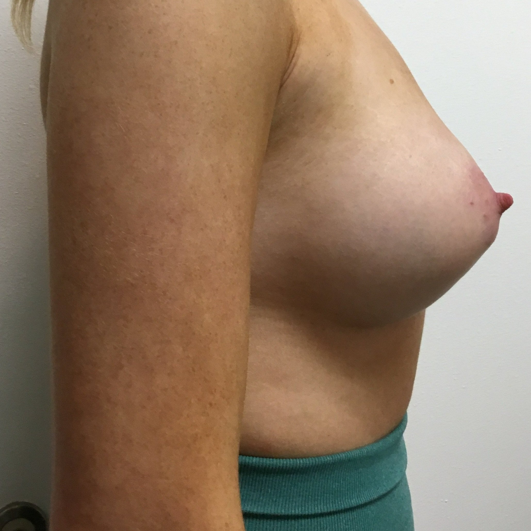 breast-lateral-right-05.24.2022-34137028.jpg