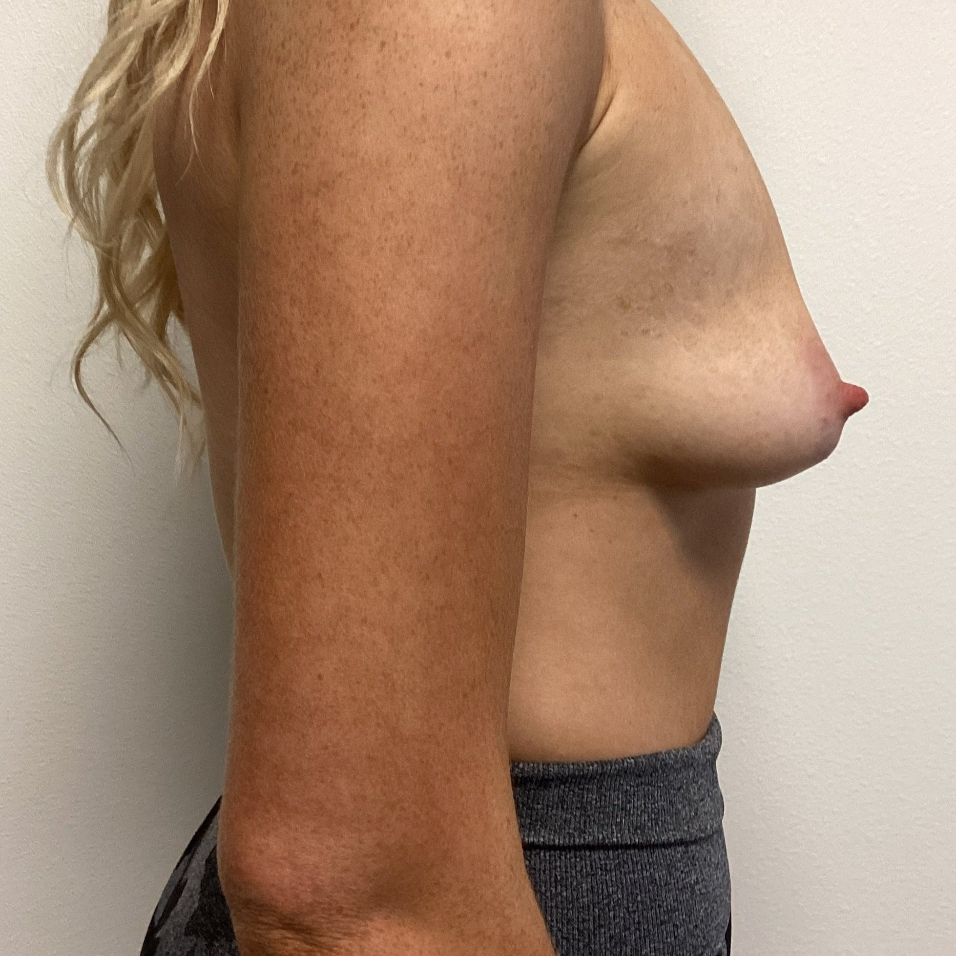 breast-anterior-oblique-right-02.03.2022-29754176.jpg