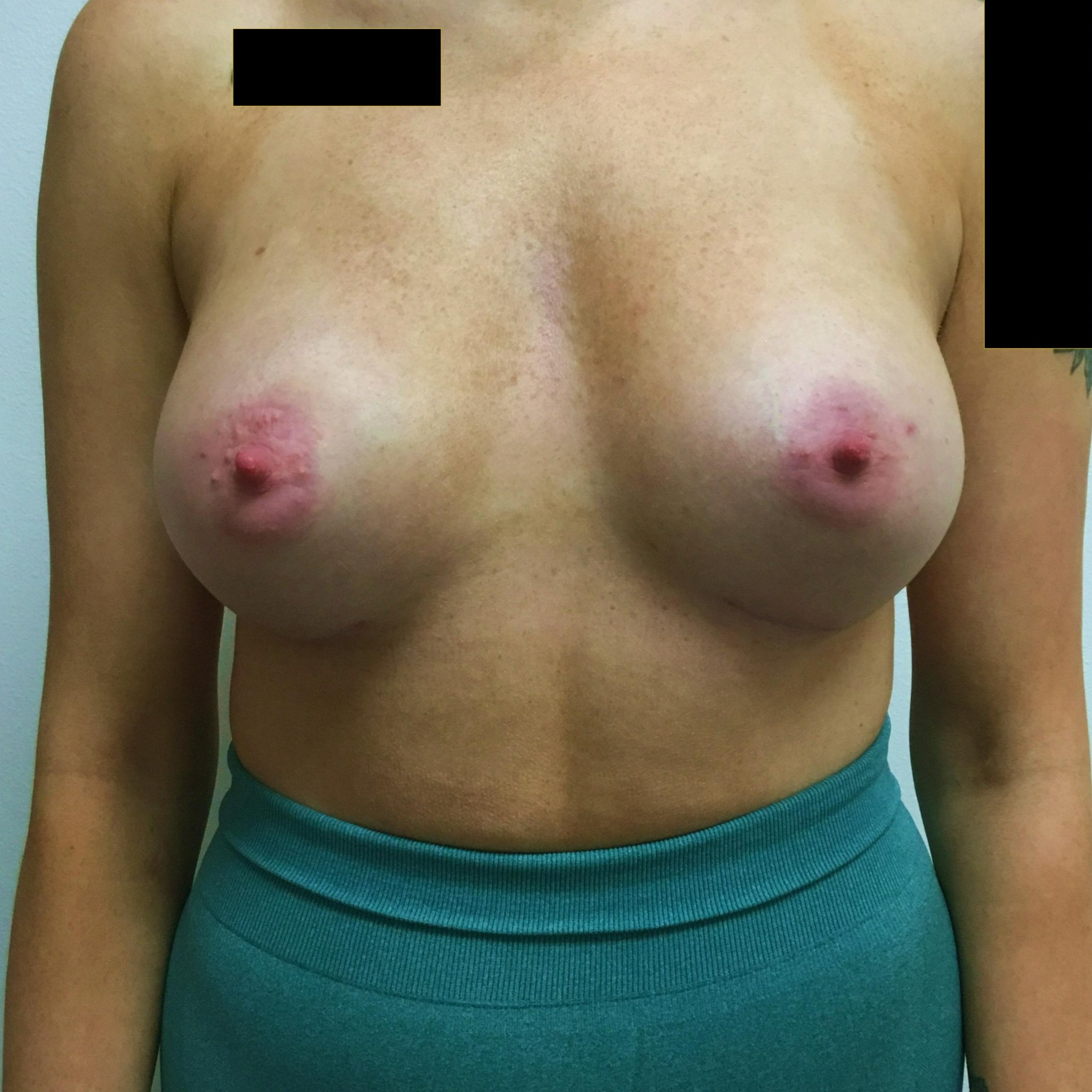 breast-anterior-05.24.2022-44467833.jpg