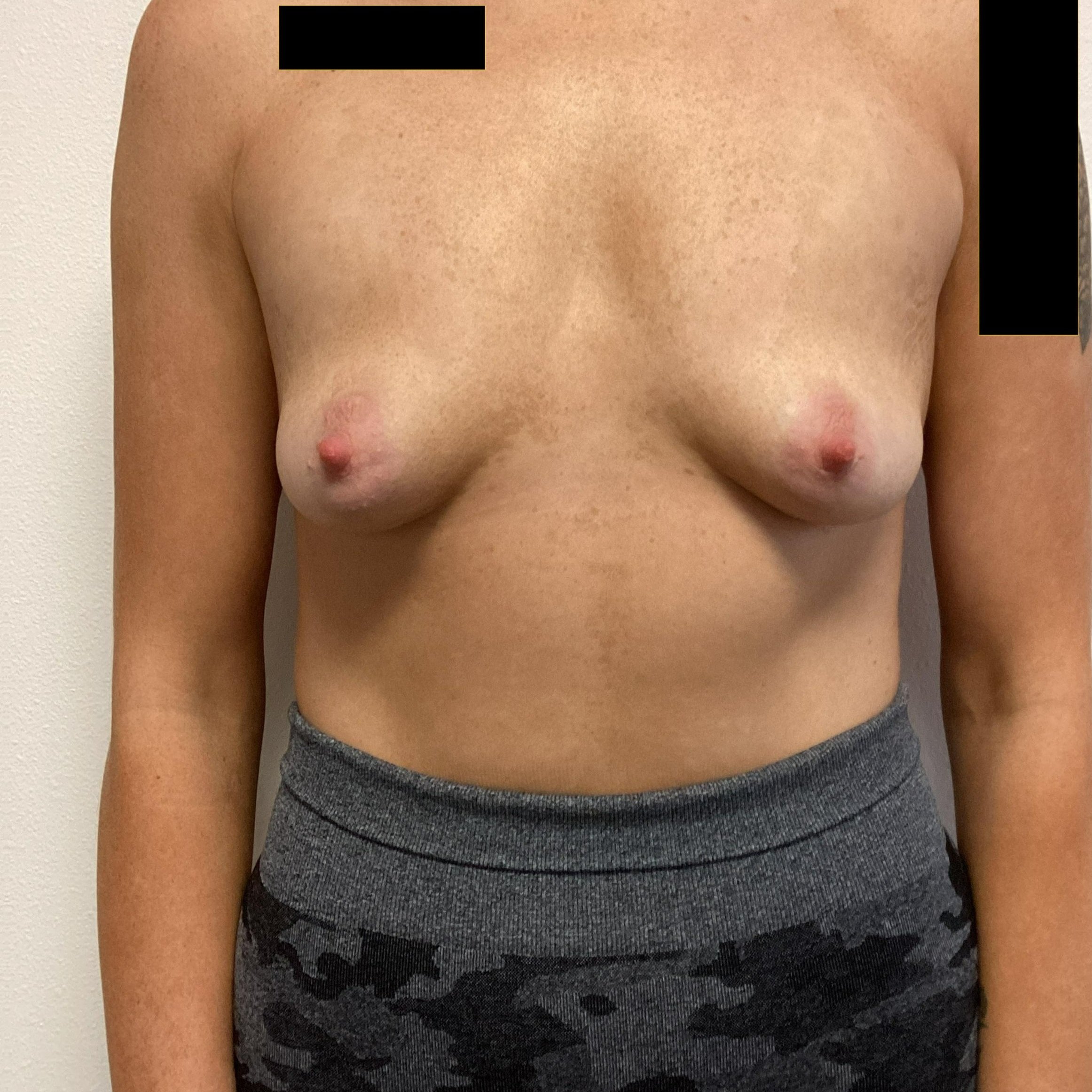 breast-anterior-oblique-left-02.03.2022-44466650.jpg