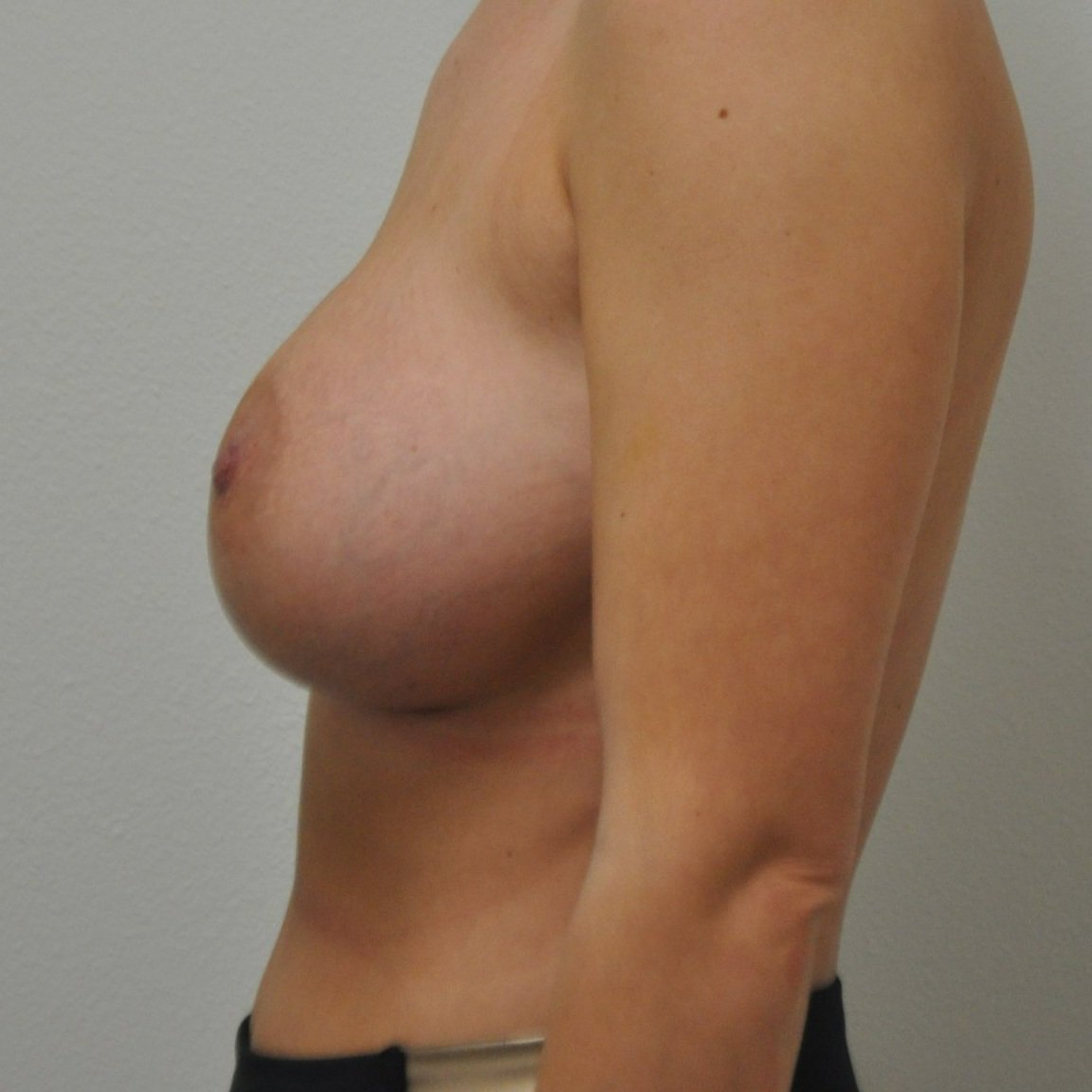 breast-lateral-left-11.04.2021-26894991.jpg