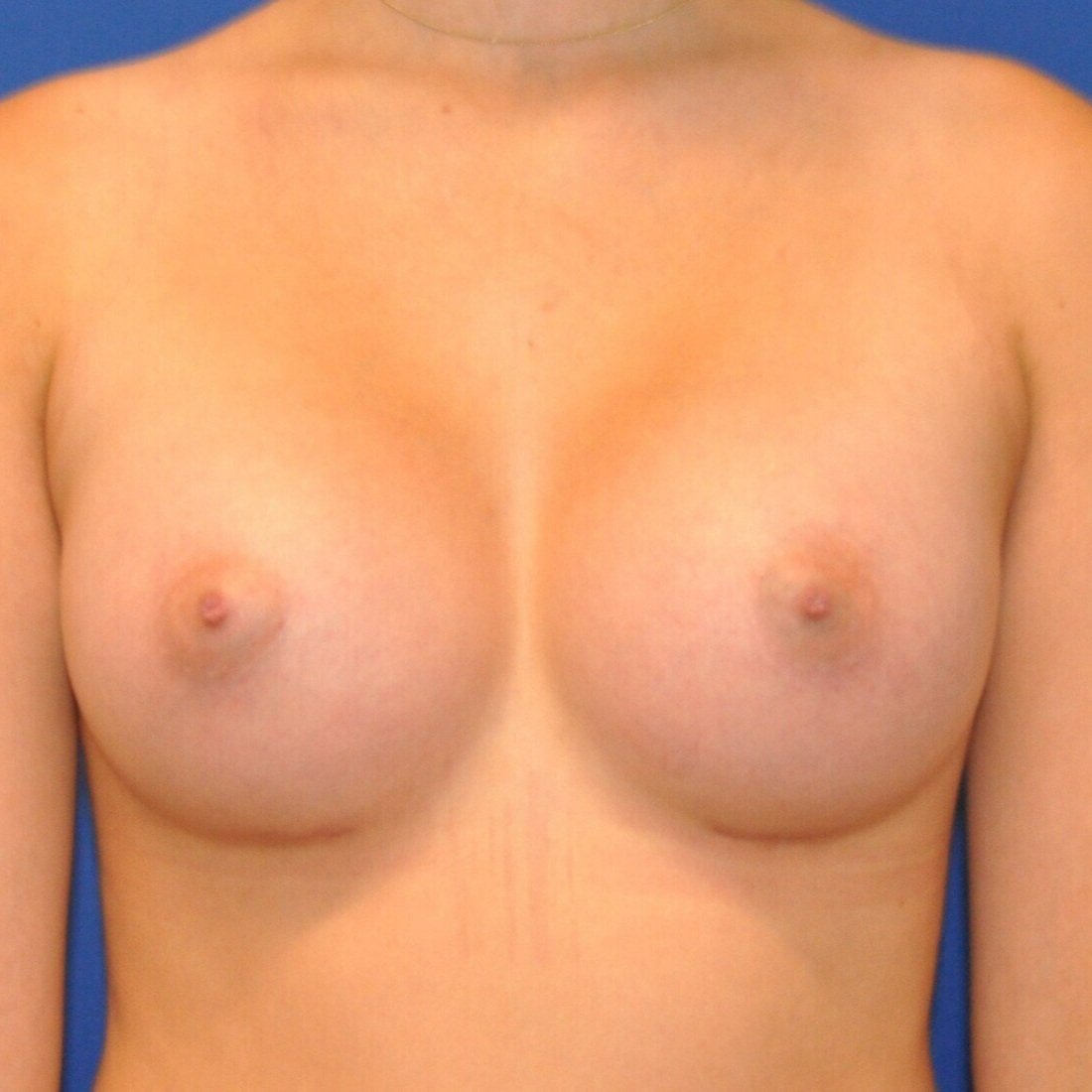 breast-anterior-09.21.2021-25377864.jpg
