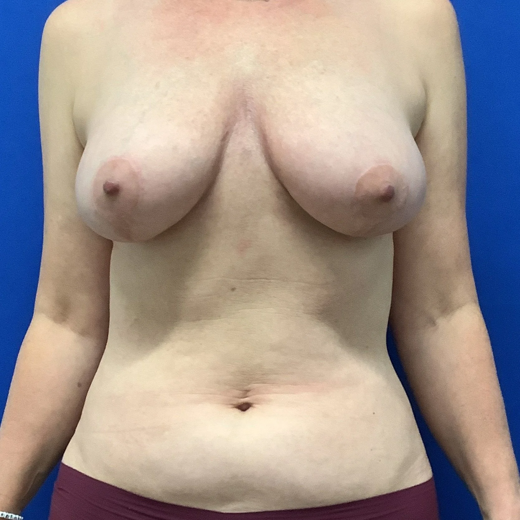 After Breast Lift