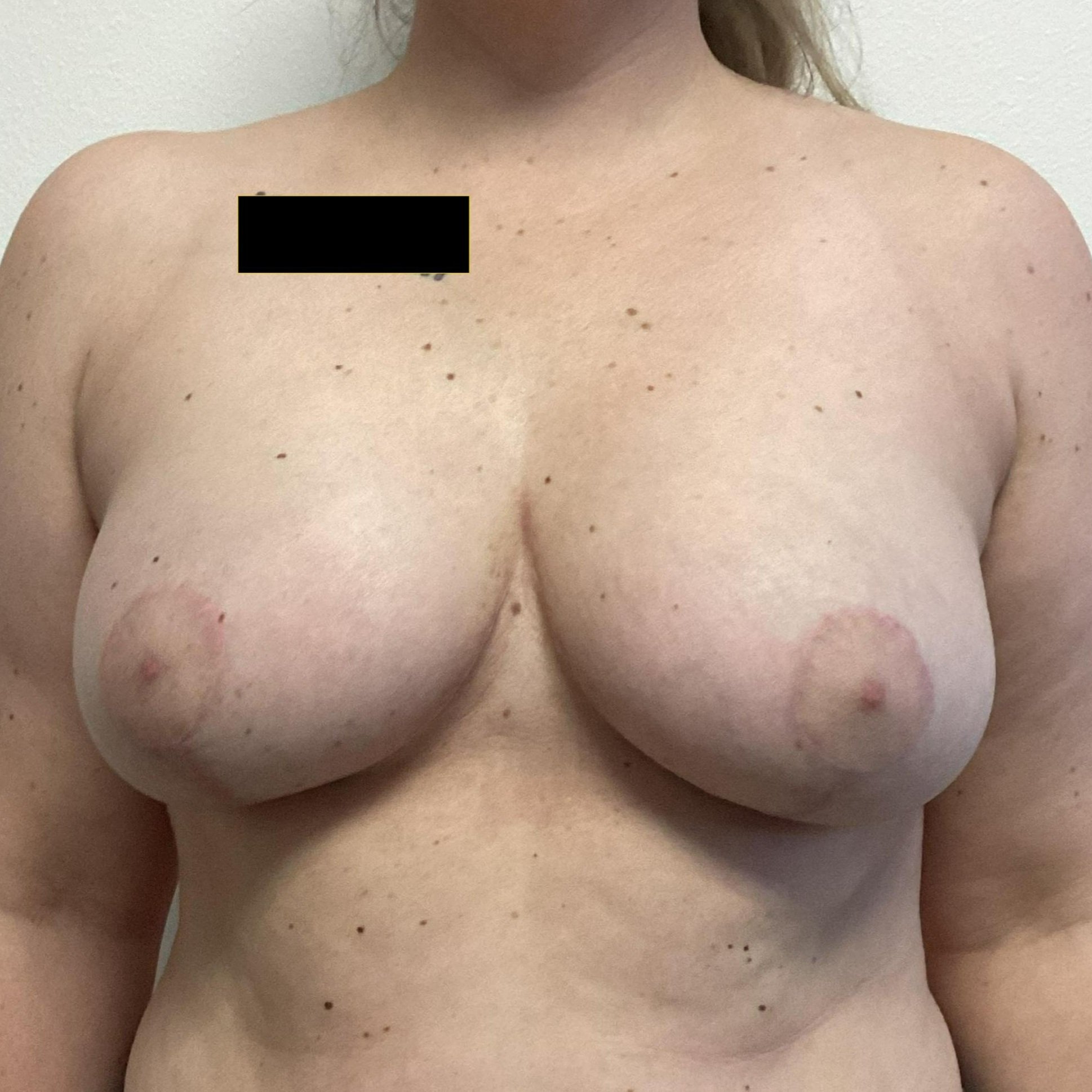 breast-anterior-01.04.2022-44408395.jpg
