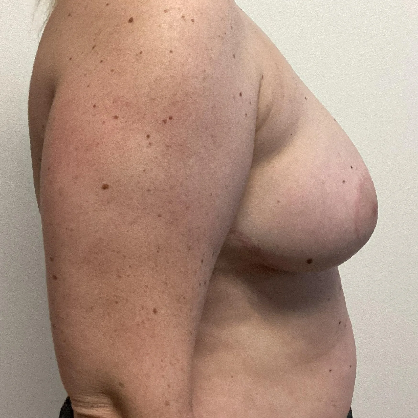 breast-anterior-oblique-right-01.04.2022-30672222.jpg
