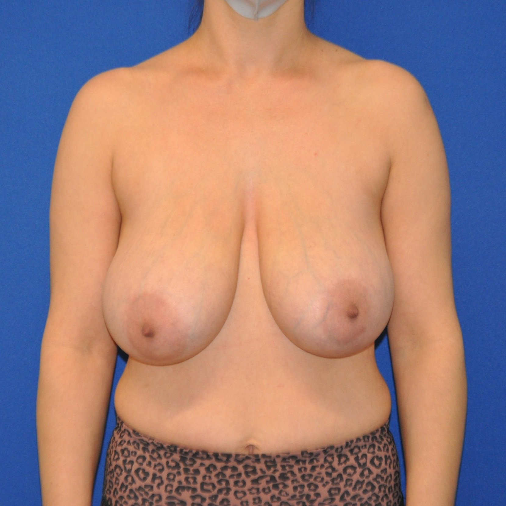 breast-anterior-04.08.2021-24695187.jpg