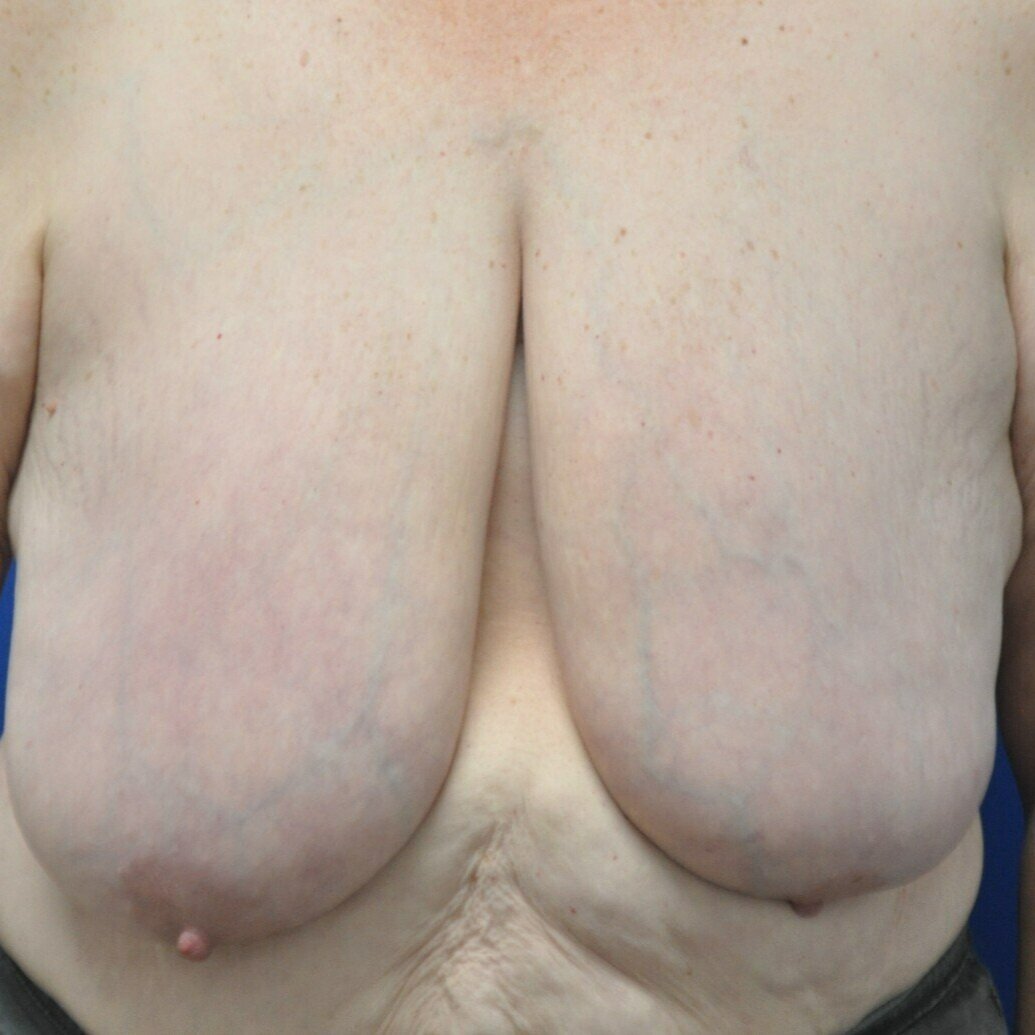 breast-reduction-and-breast-lift-pre-op-1920-1035.jpg