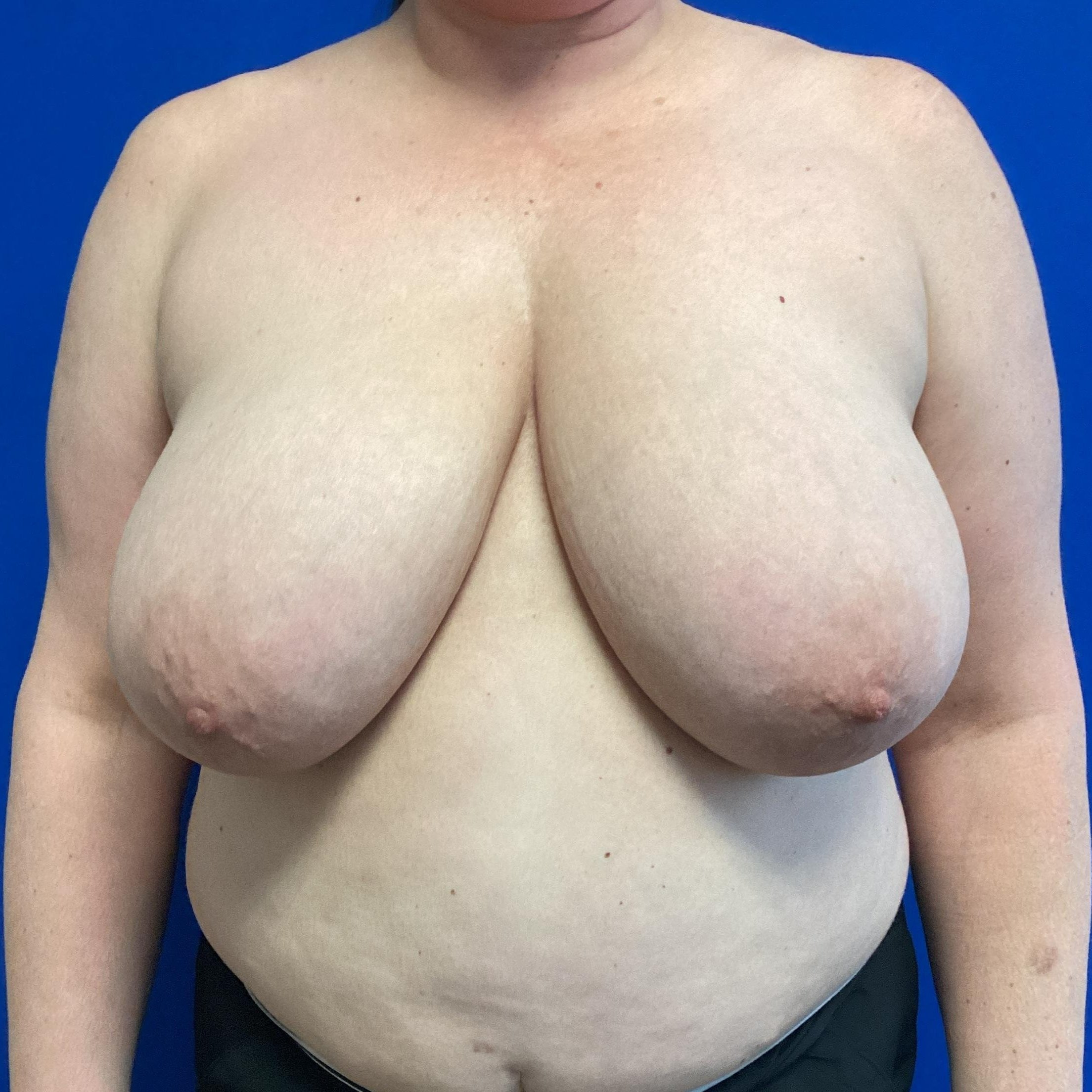 bilateral+breast+reduction+before.jpg