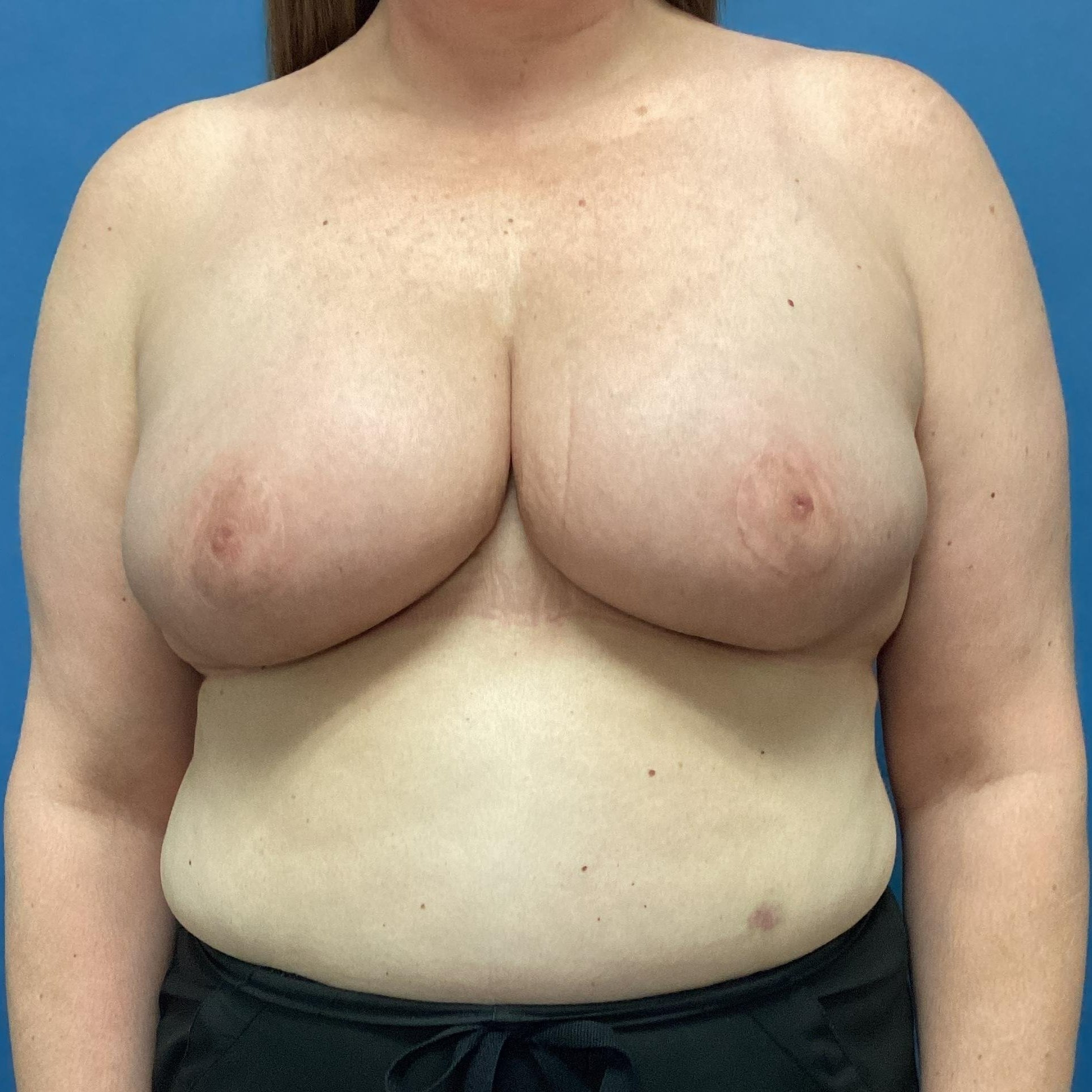 4mo+post+bilateral+breast+reduction.jpg